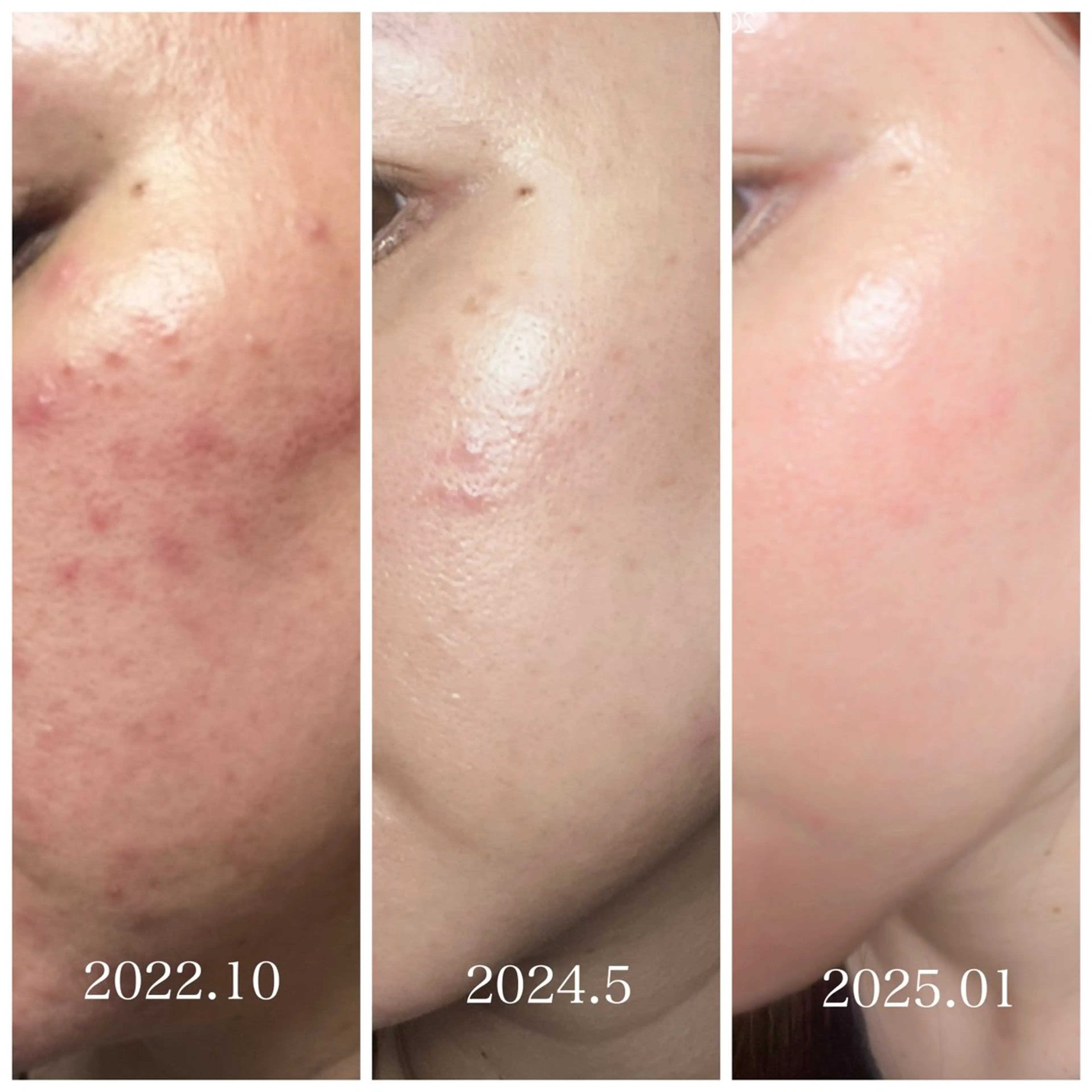 【ミニモ学割】ニキビ、ニキビ跡にはコレ！肌トラブルを鎮静させるフェイシャルエステ。の写真