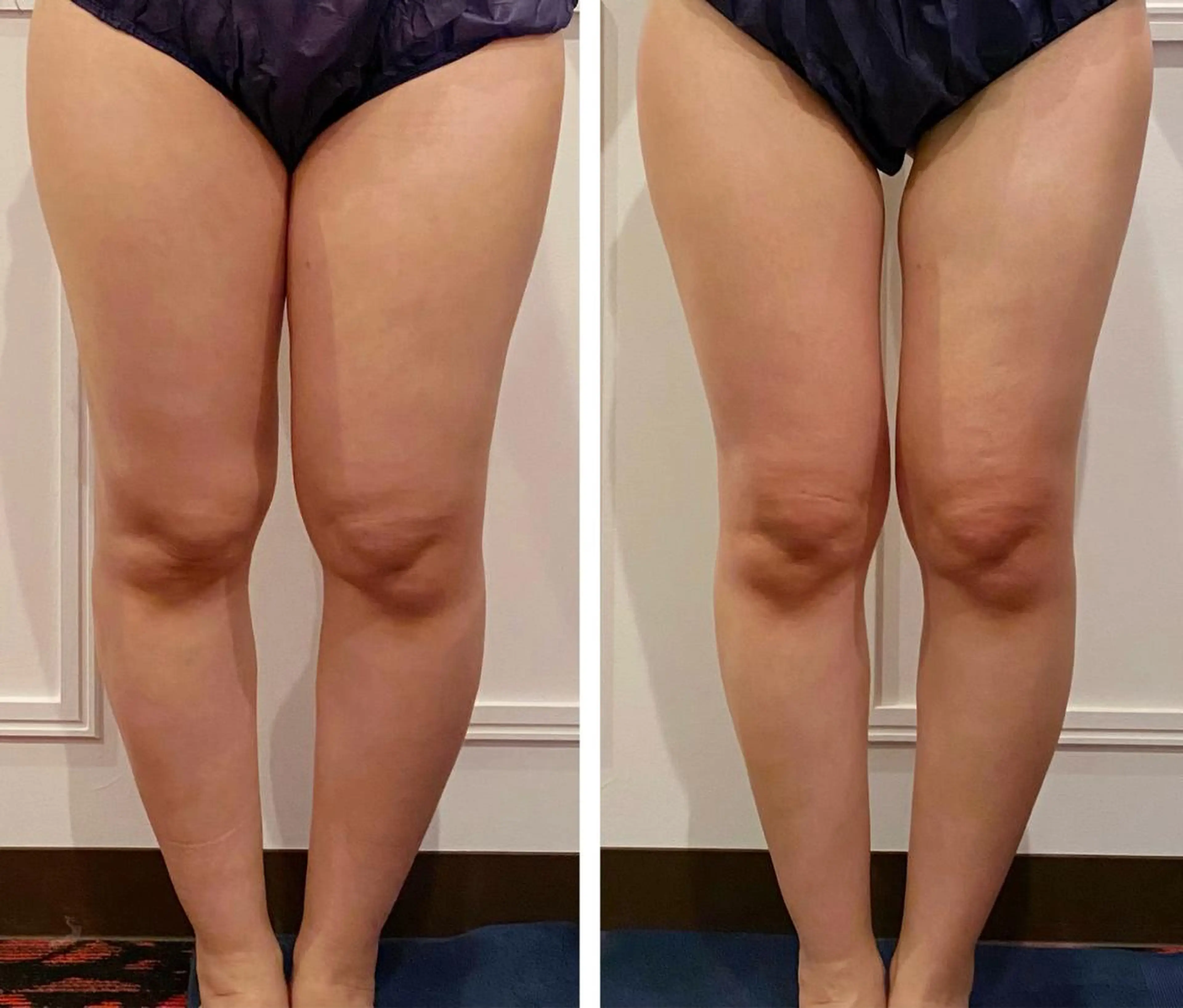 【当日予約限定‼️】冷え症解消🔥血行促進×むくみ解消🔥ハイパーナイフEX下半身集中❤️驚きの変化を体感してください✨の写真