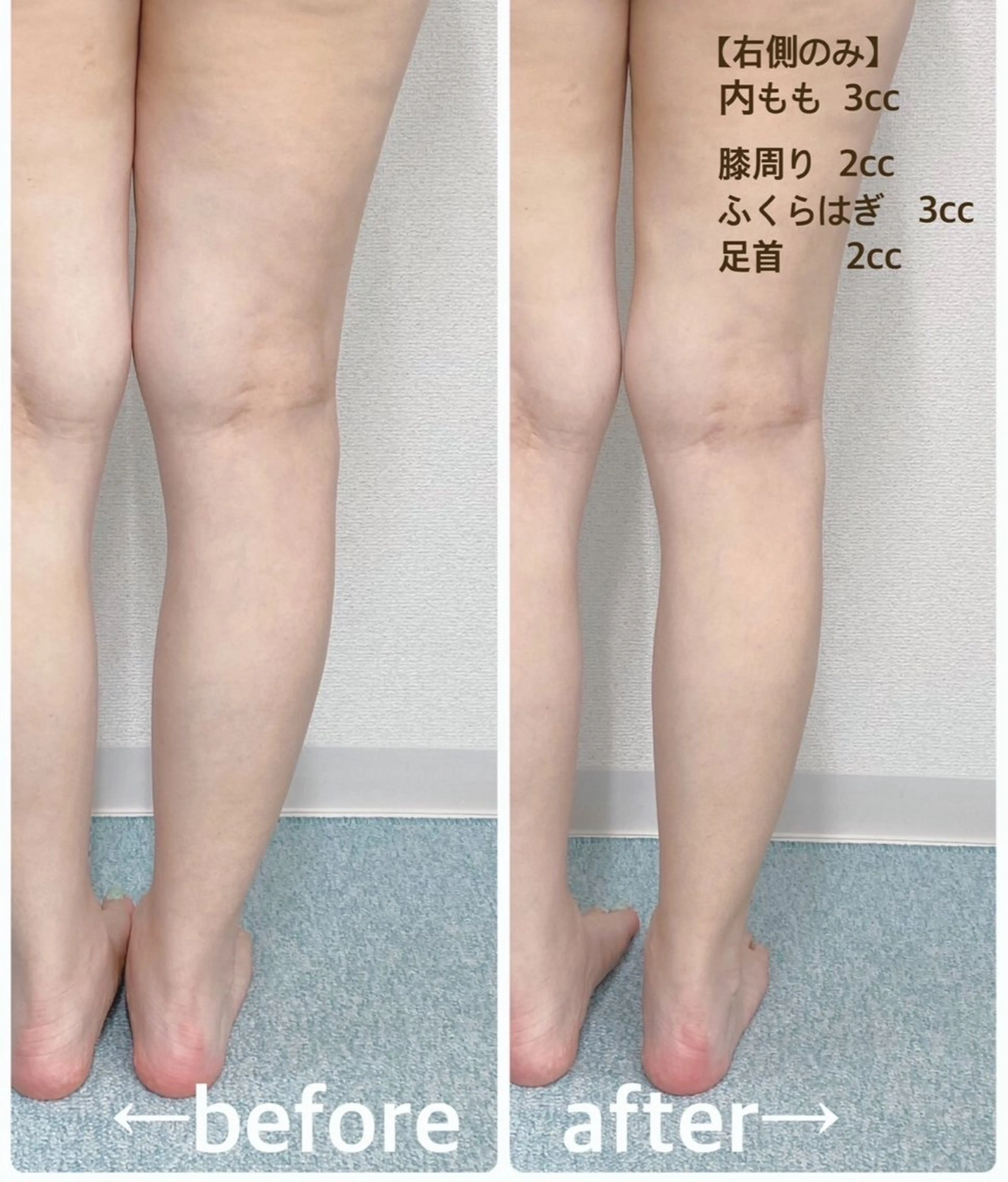 【６０分】韓国🍋強力痩せボディレモン1部位🍋6ccボトルの写真