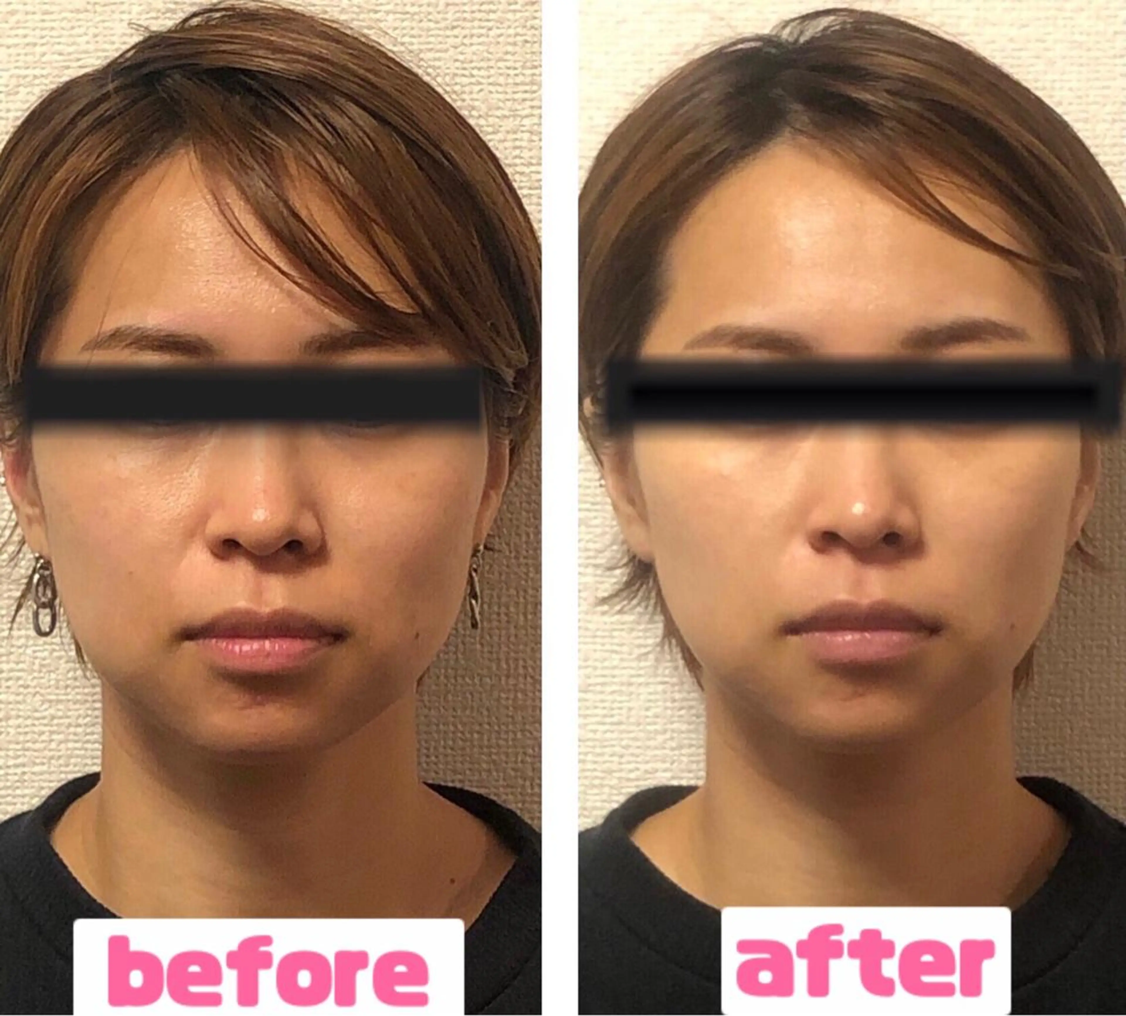 ✨ミニモ限定✨肌管理🌹Venus lineフェイシャル+保湿鎮静パック（っ ‘ ᵕ ‘ ｃ）の写真