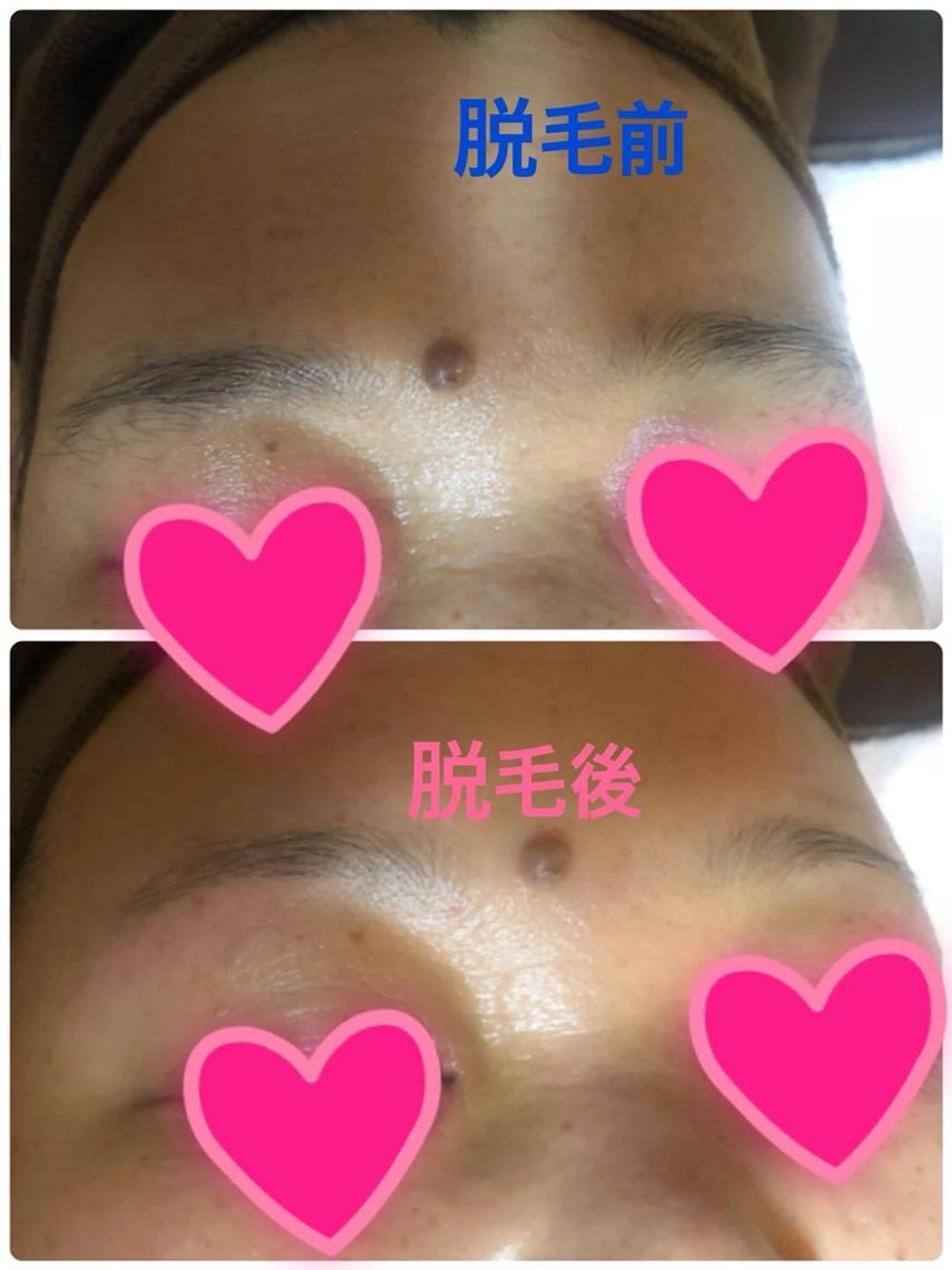 WAX脱毛（顔）の写真