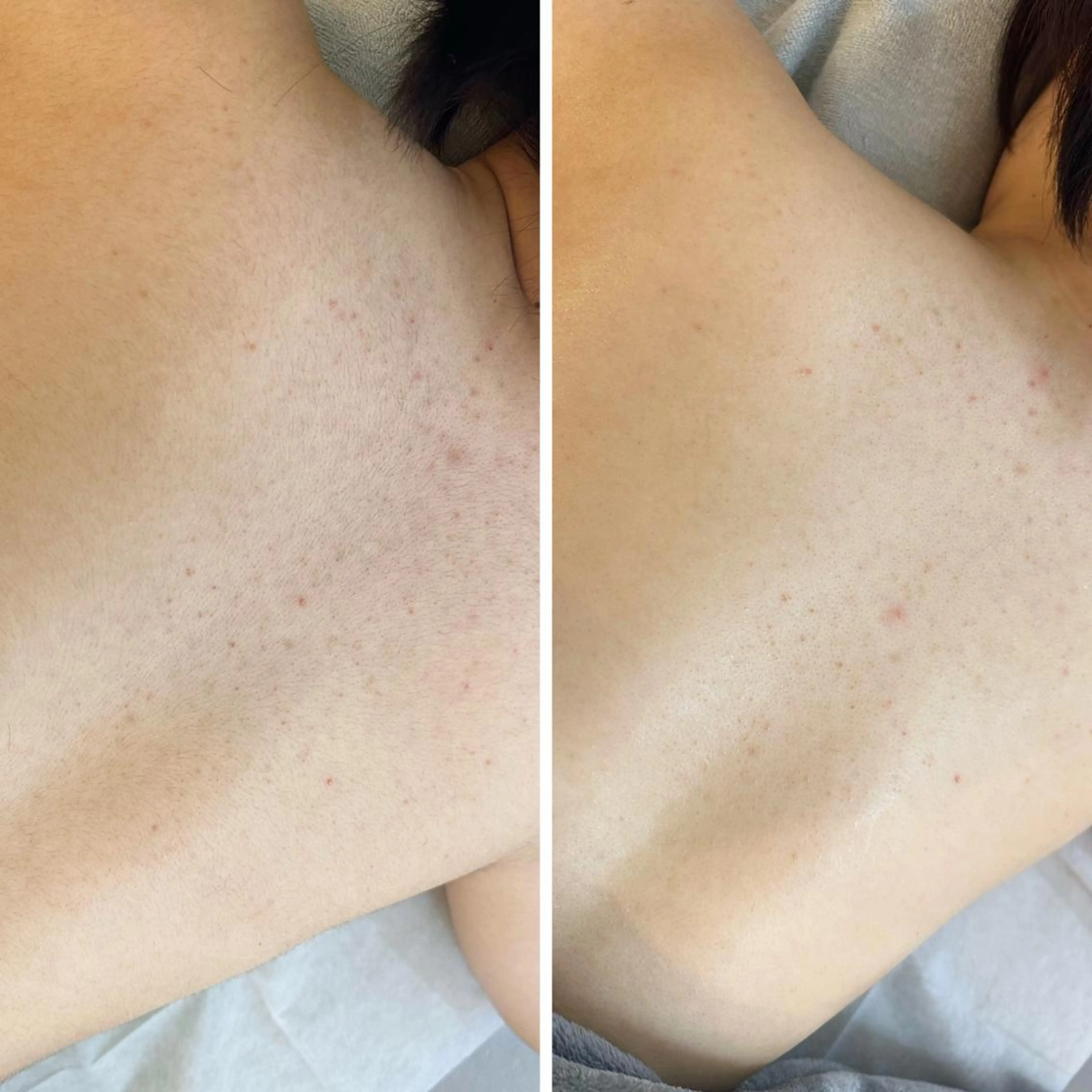 うなじ脱毛/美肌脱毛 LABELのエステ・リラクイメージ