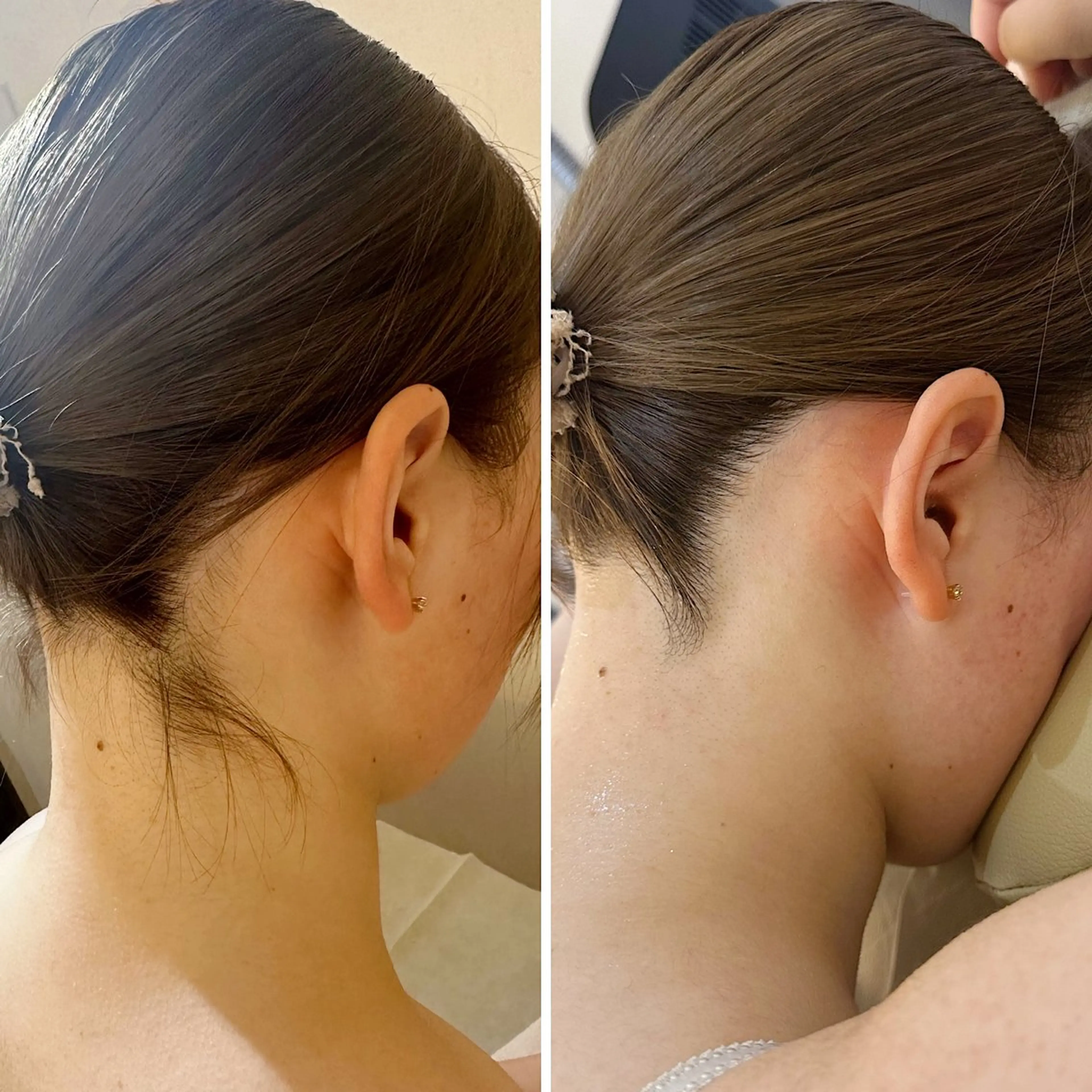 脱毛 うなじ脱毛/美肌脱毛 LABELのエステ・リラクイメージ