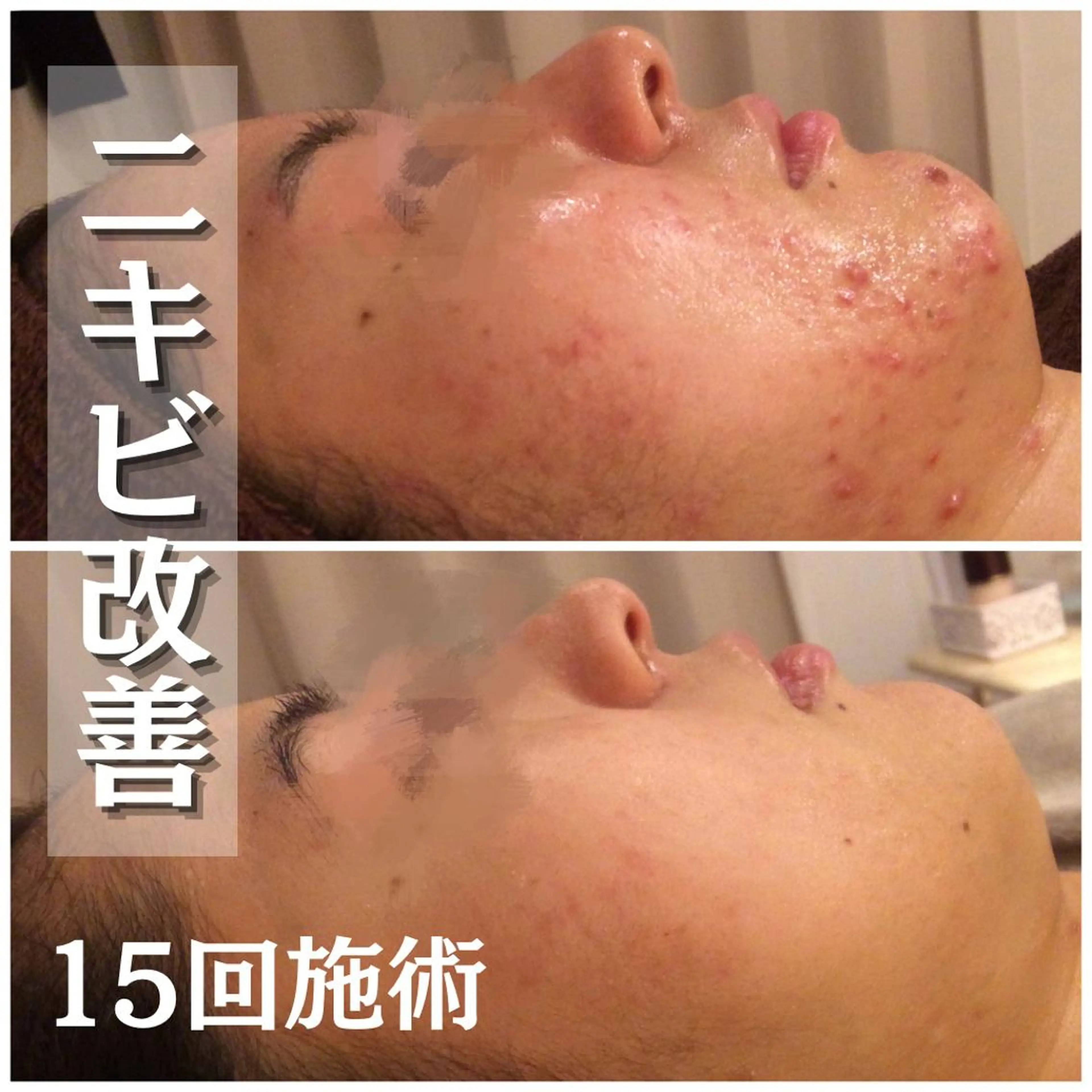 セミロング カラー パーマ ヘアアレンジ メンズ キッズ ネイル マツエク・マツパ アイブロウ ニキビ特化型エステ 🍓最短で肌質改善のエステ・リラクイメージ