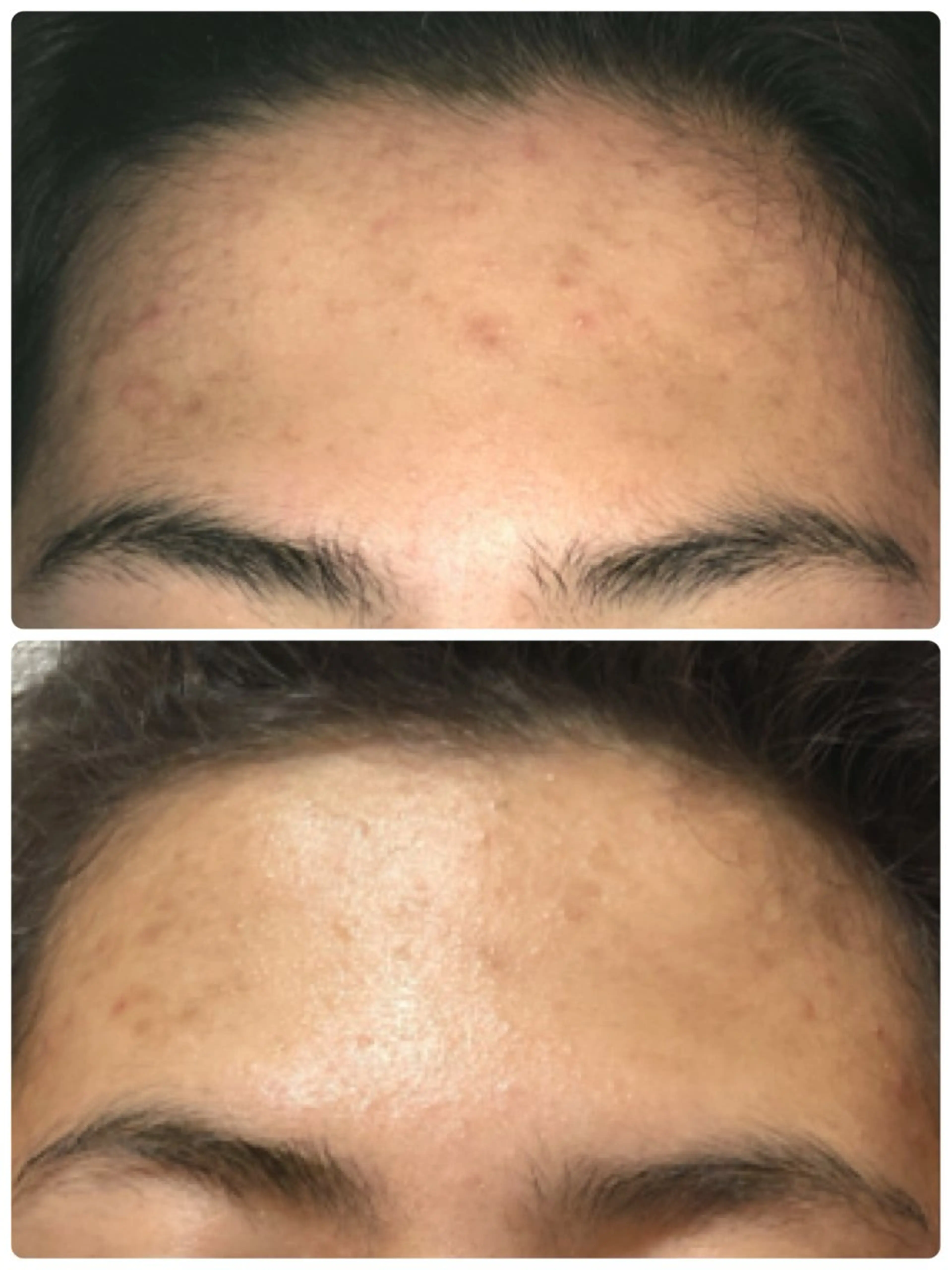 肌質改善におすすめ!【ハーブピーリング 顔 50分】の写真