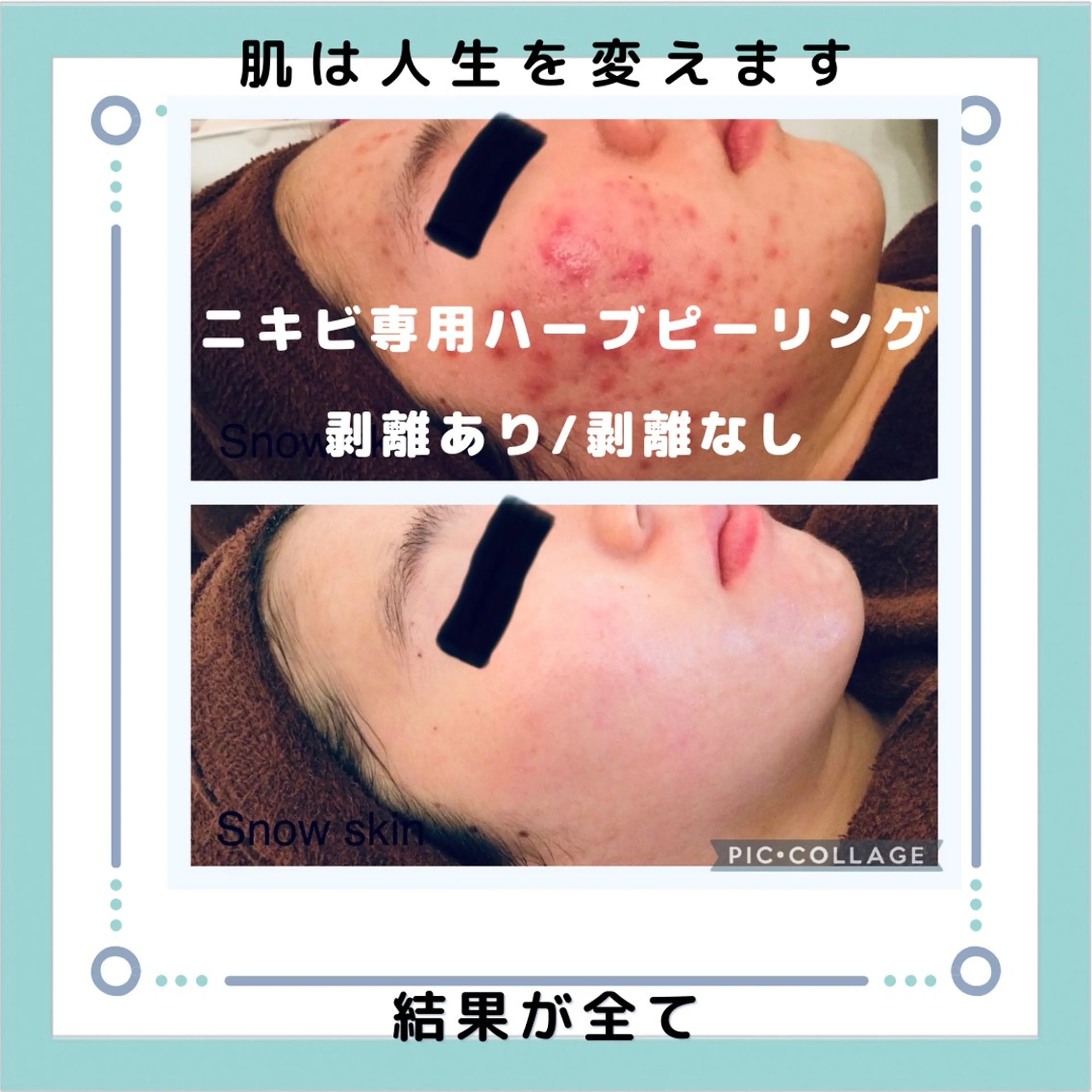 ニキビ/肌質改善専門 Snow skinのエステ・リラクイメージ