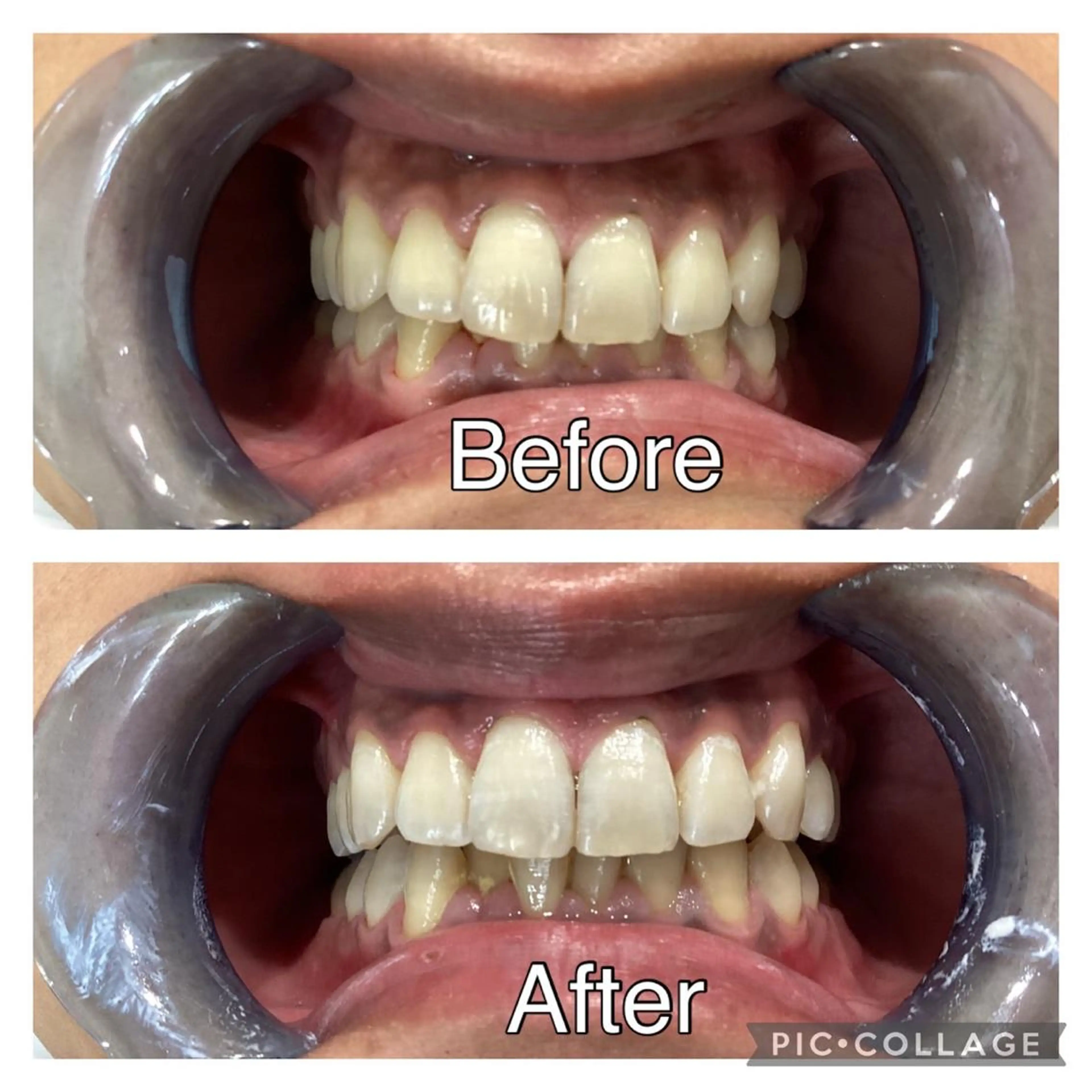 🦷✨体験セルフホワイトニング💎の写真