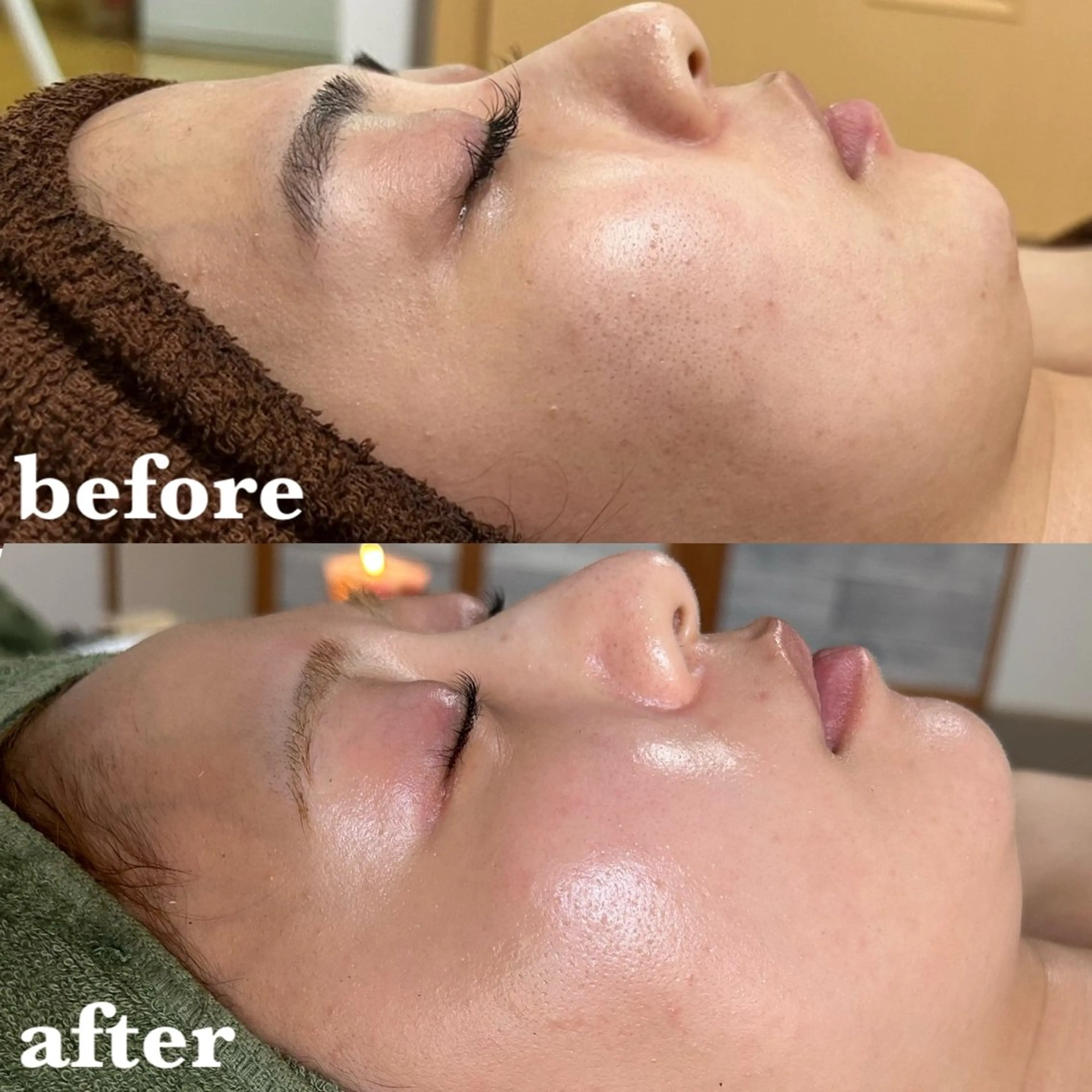 【毛穴汚れ･毛穴の開き】陶肌トリートメント▶¥8,800(陶肌パウダー1ｇプレゼント価格)の写真