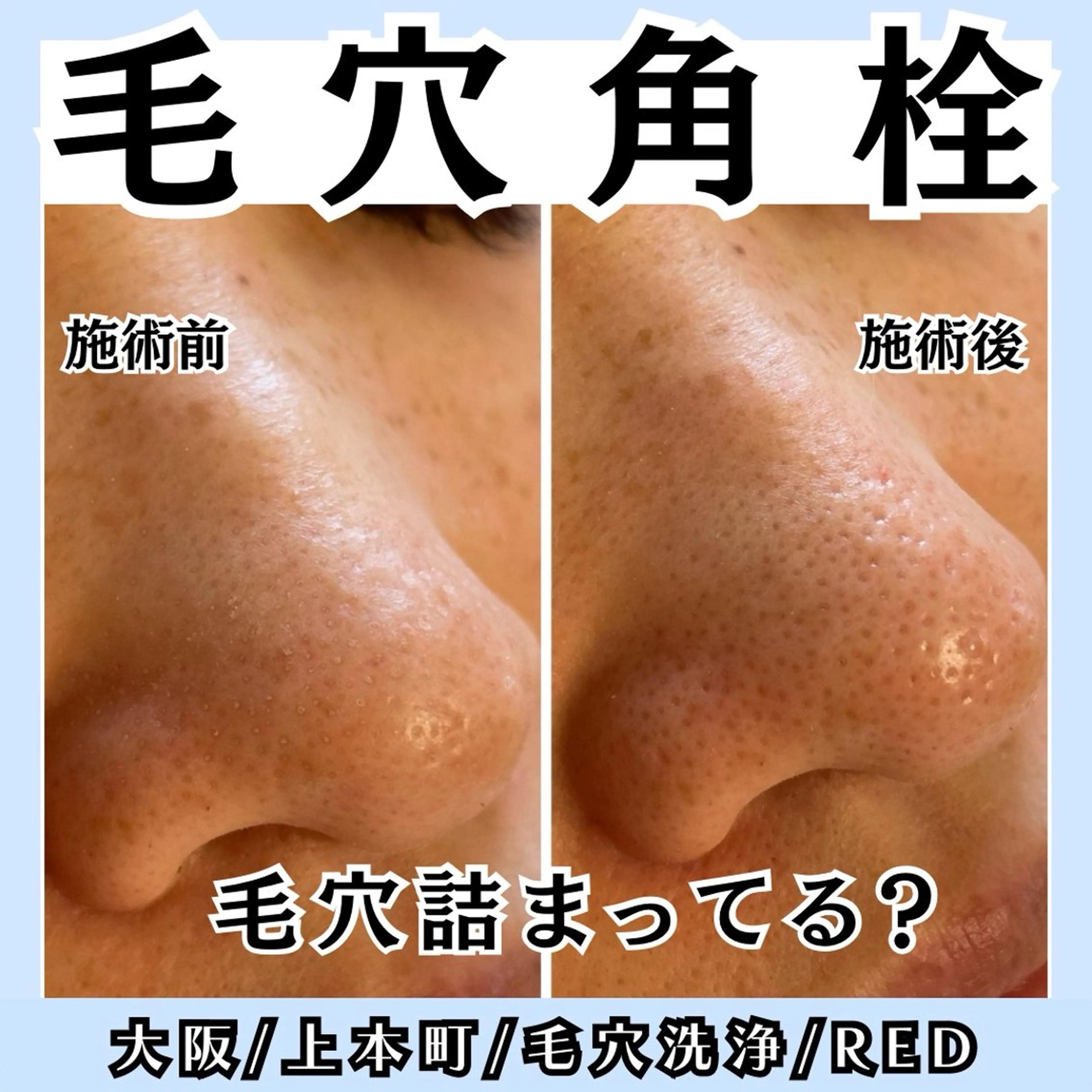 毛穴レス ハーブ& ワックス脱毛×光脱毛のエステ・リラクイメージ