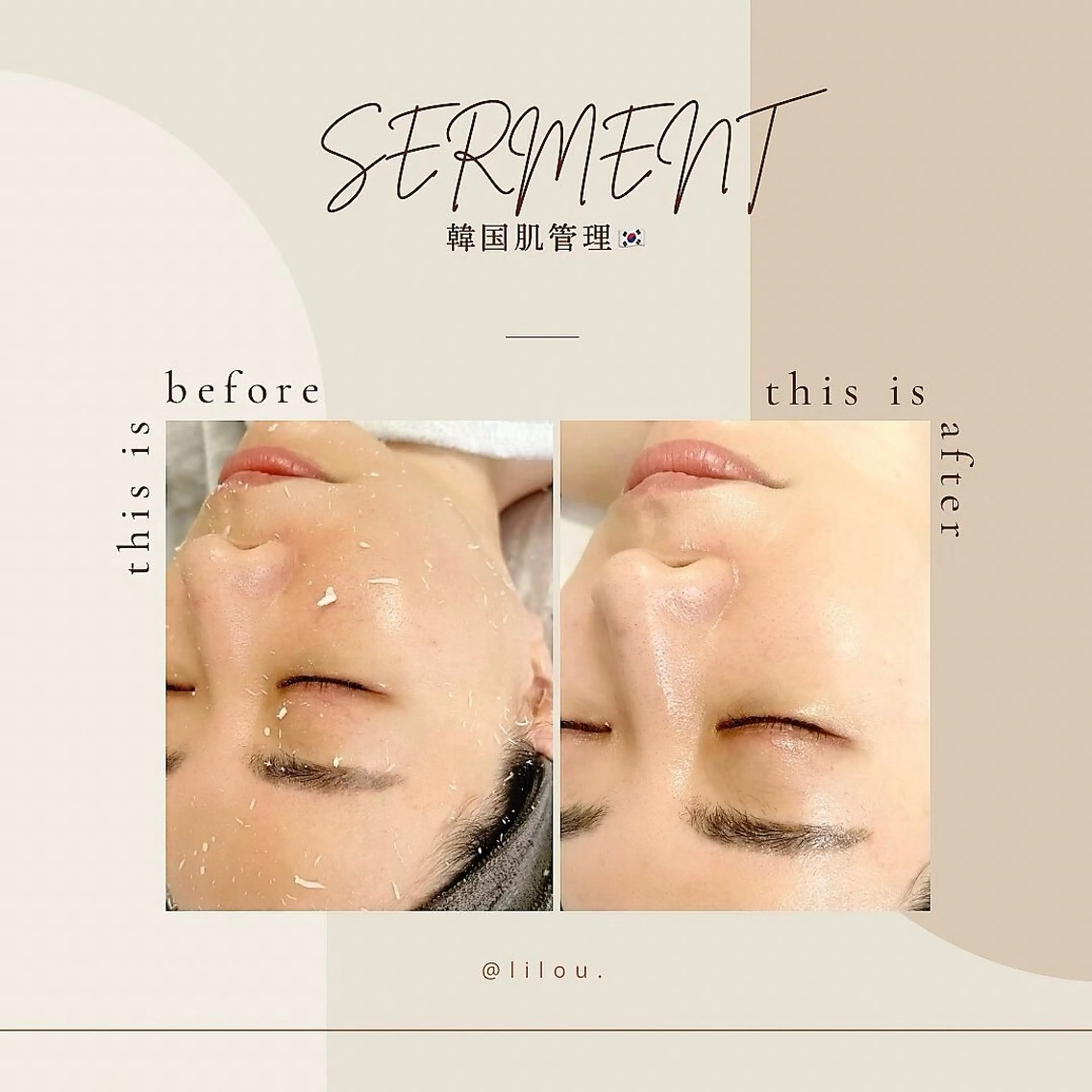 人気no.1‼️🇰🇷韓国艶肌🇰🇷 毛穴撲滅‼️肌質改善ピーリングの写真