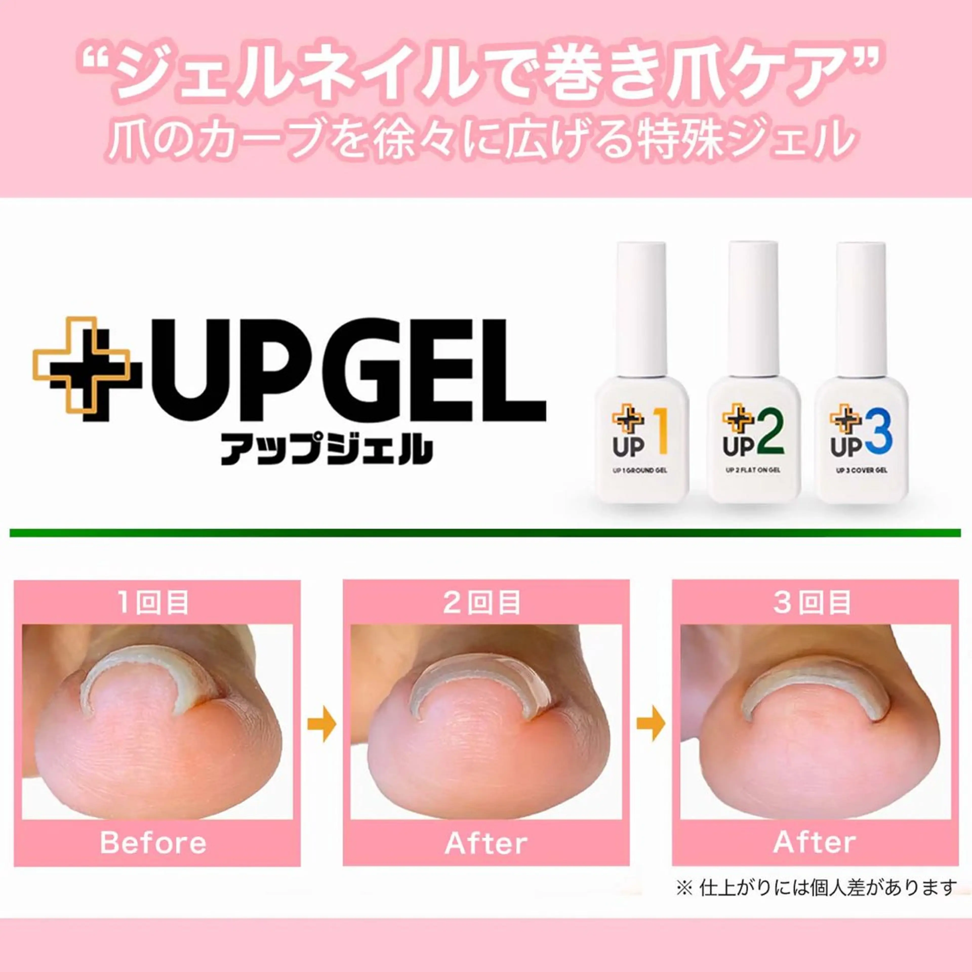 巻き爪ケア　UPジェル　足指1本の写真