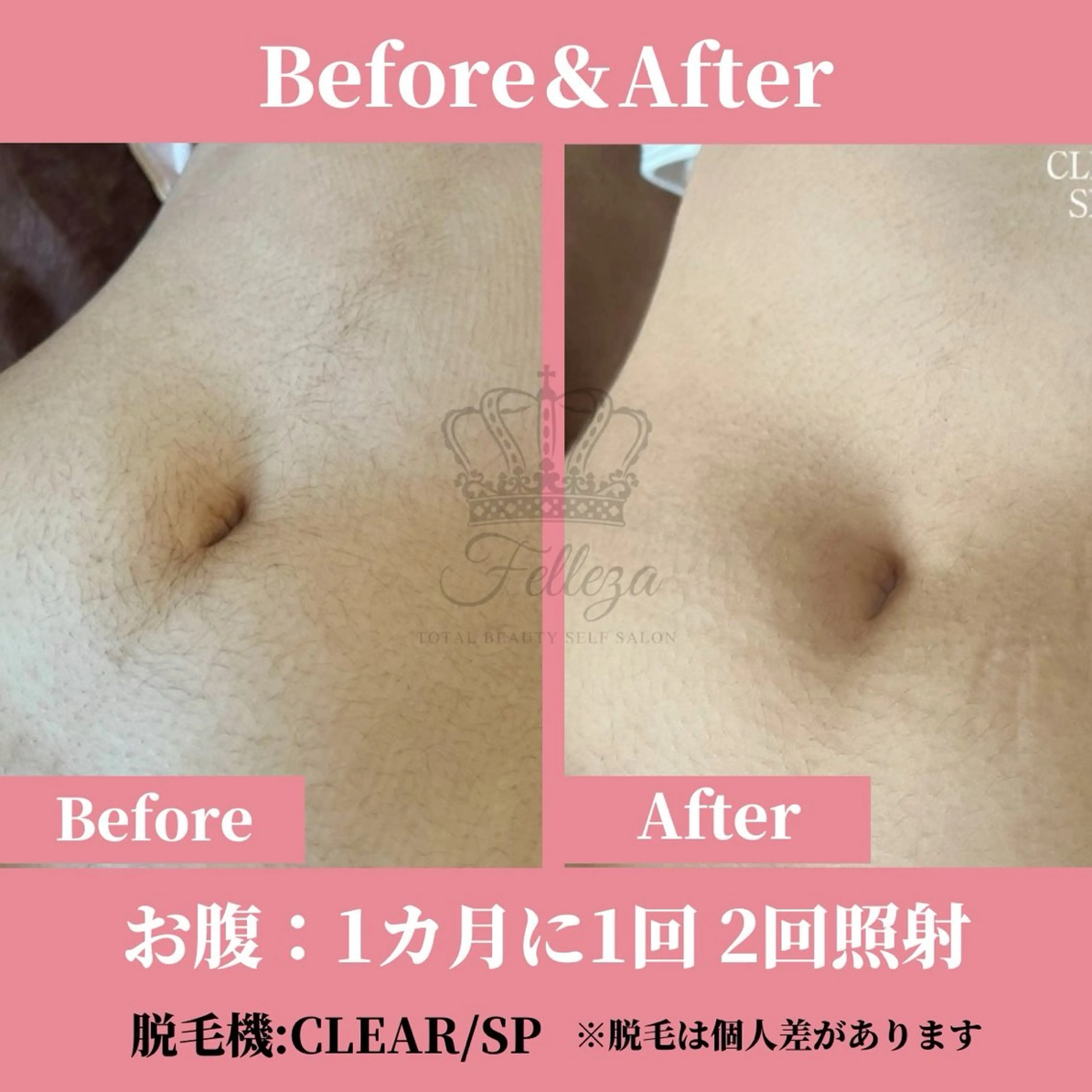 メンズ キッズ 有人型セルフサロン 脱毛／痩身／美顔のその他イメージ