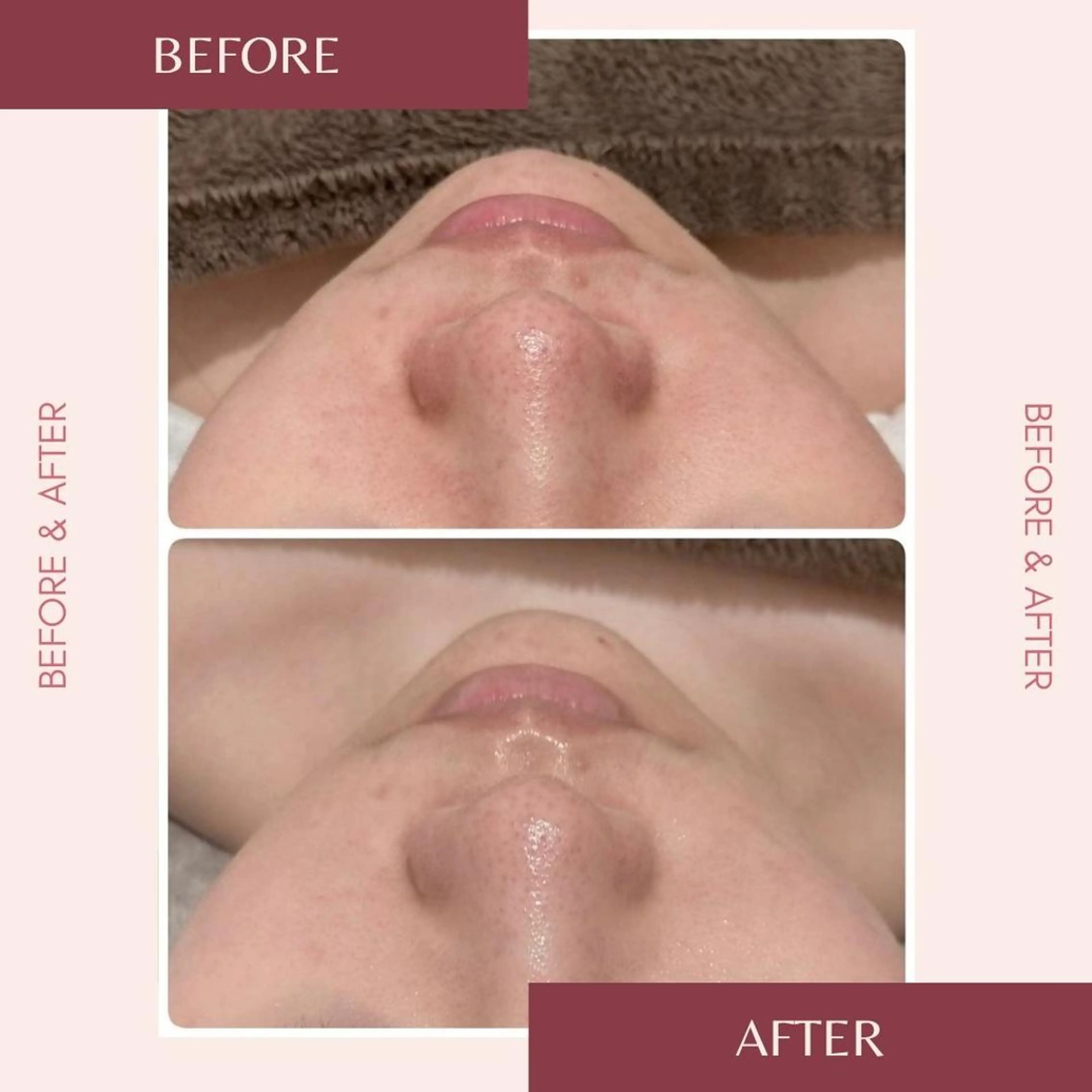 メンズ 頭蓋骨小顔矯正 ハーブピーリングのエステ・リラクイメージ