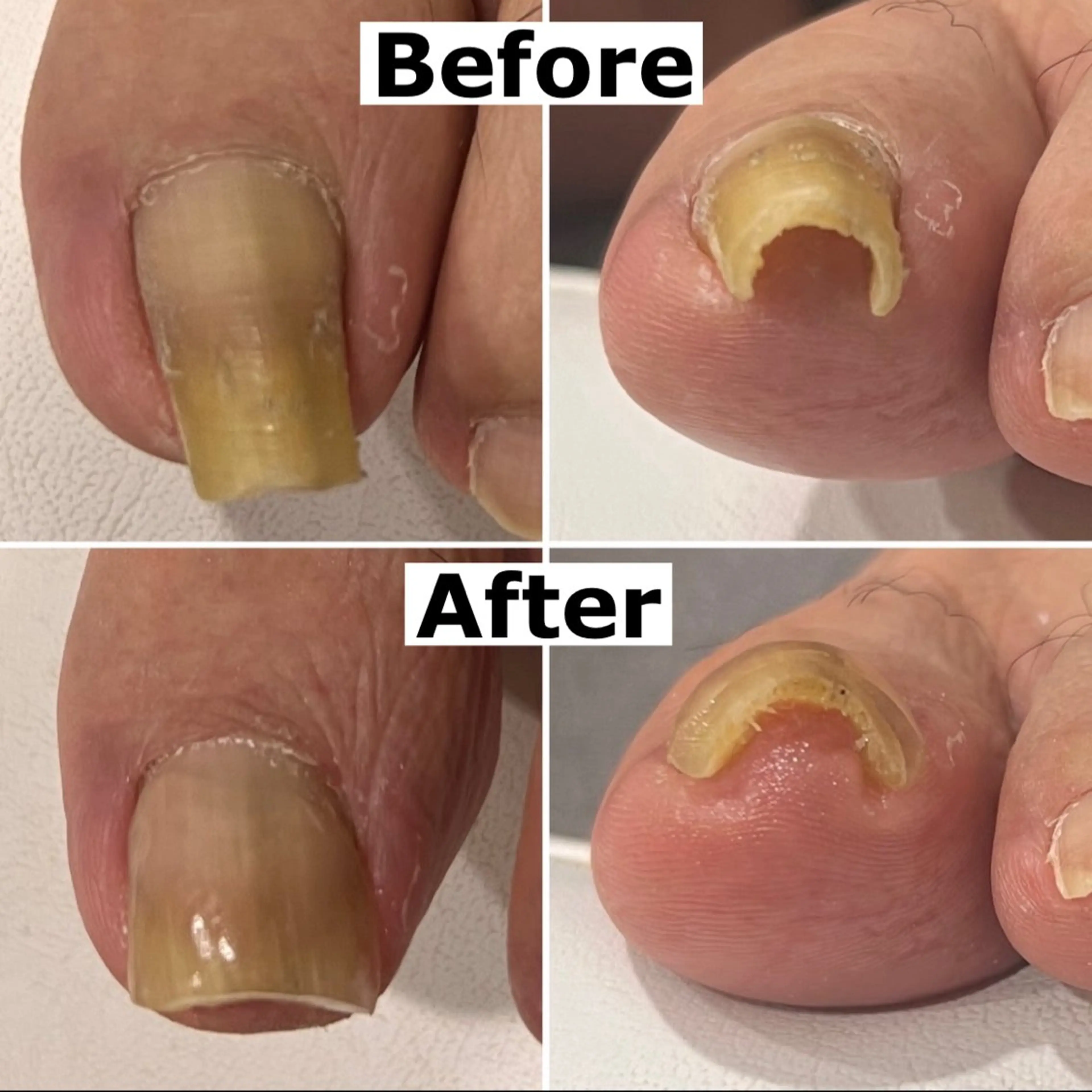 ネイル Mellow nail所属・巻爪無料モデル募集 ✨🦶MEGUMIのネイルデザイン