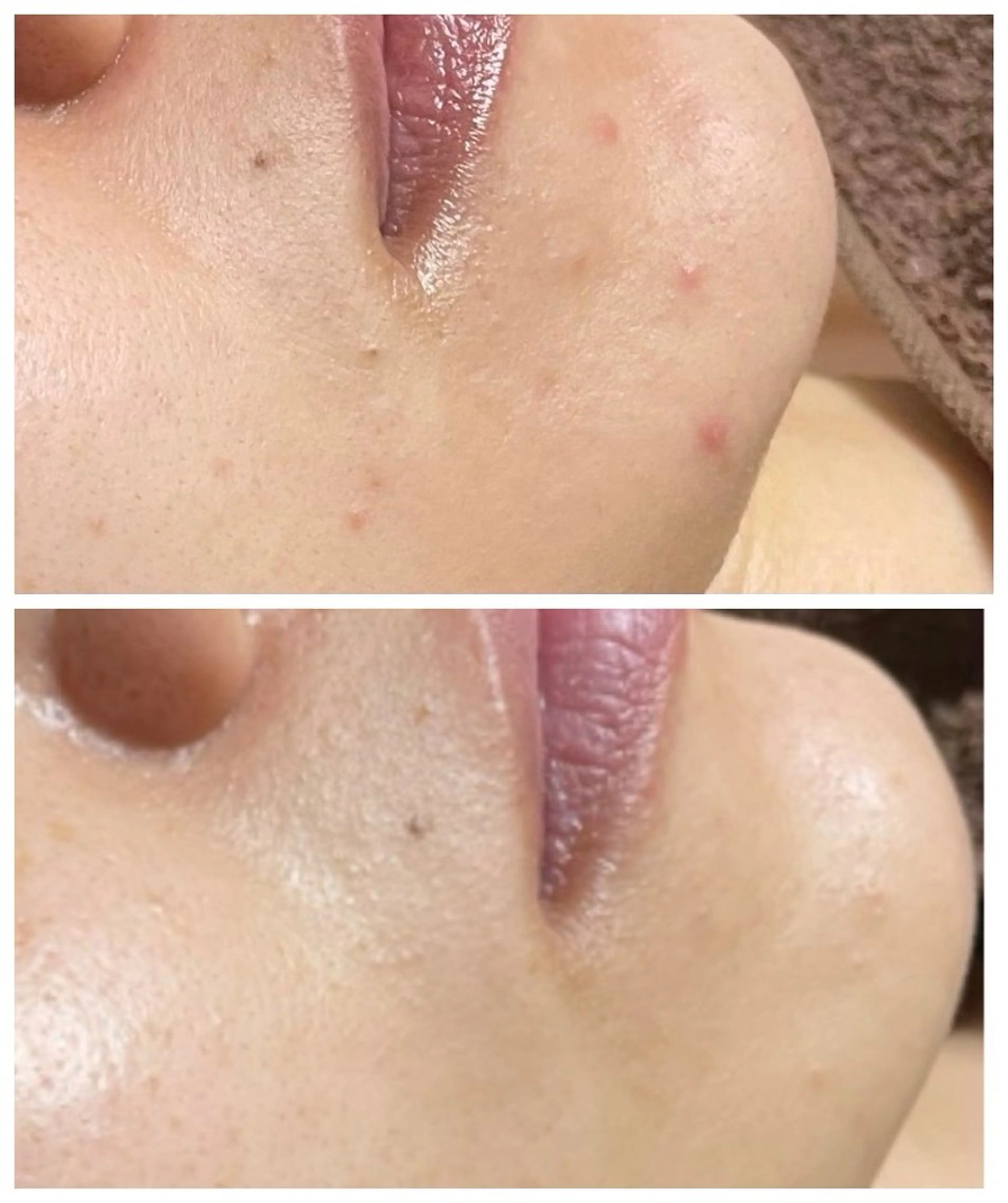 アゴ毛穴エクストラクションの写真