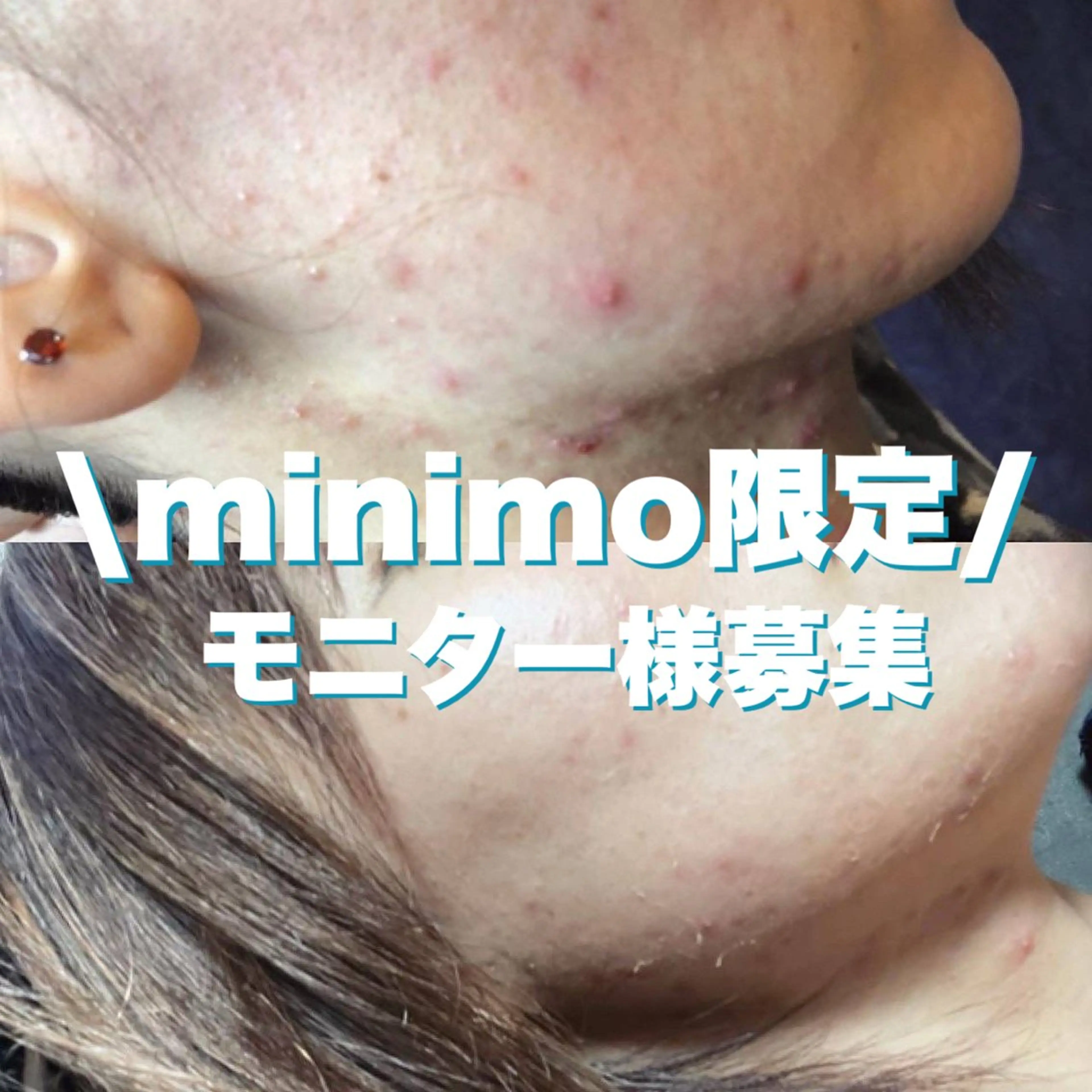 【平日限定】ハーブピーリングピーリング撮影モデルの写真