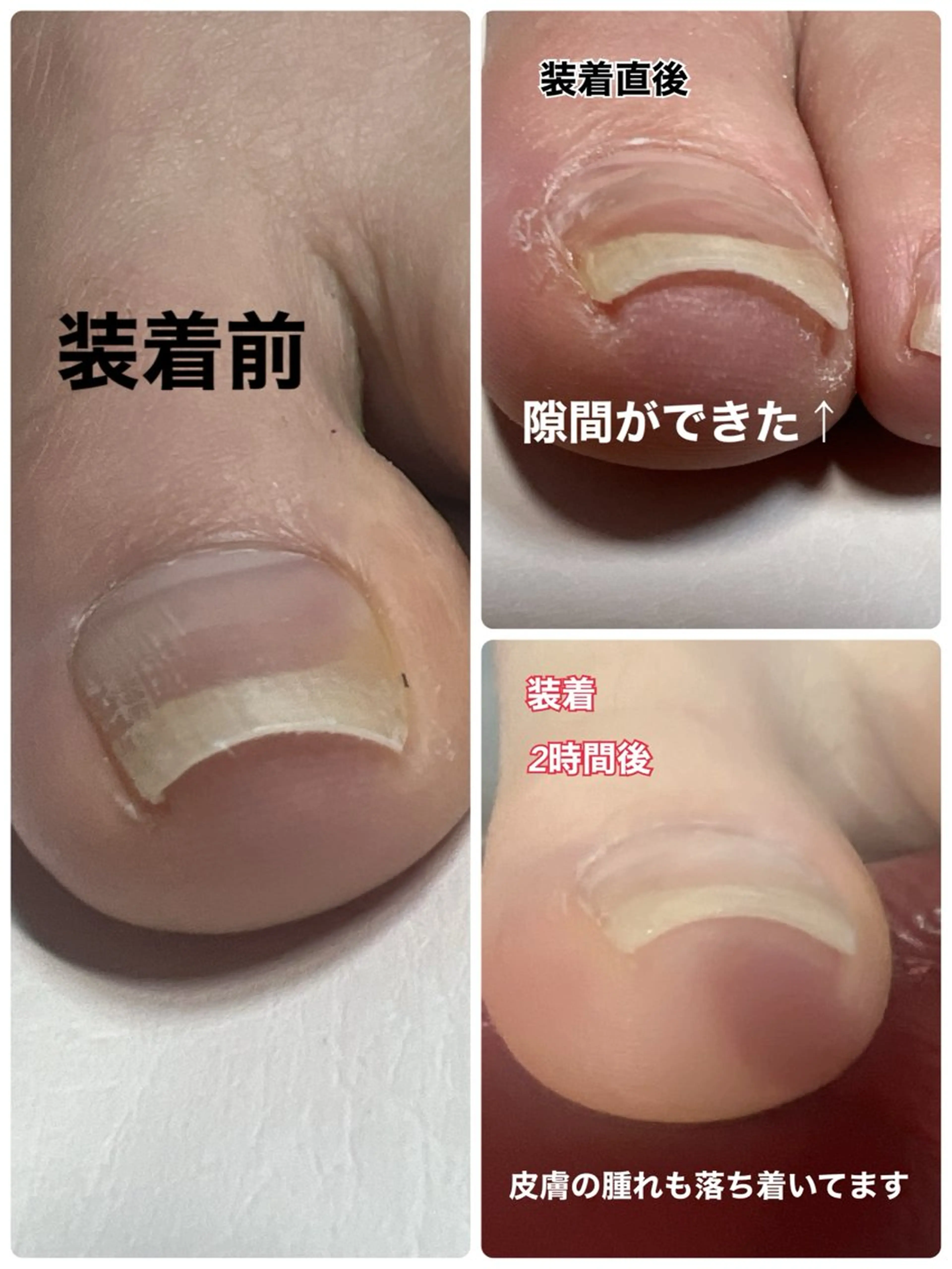 巻き爪解放*レジスタンスプレート両親指の写真