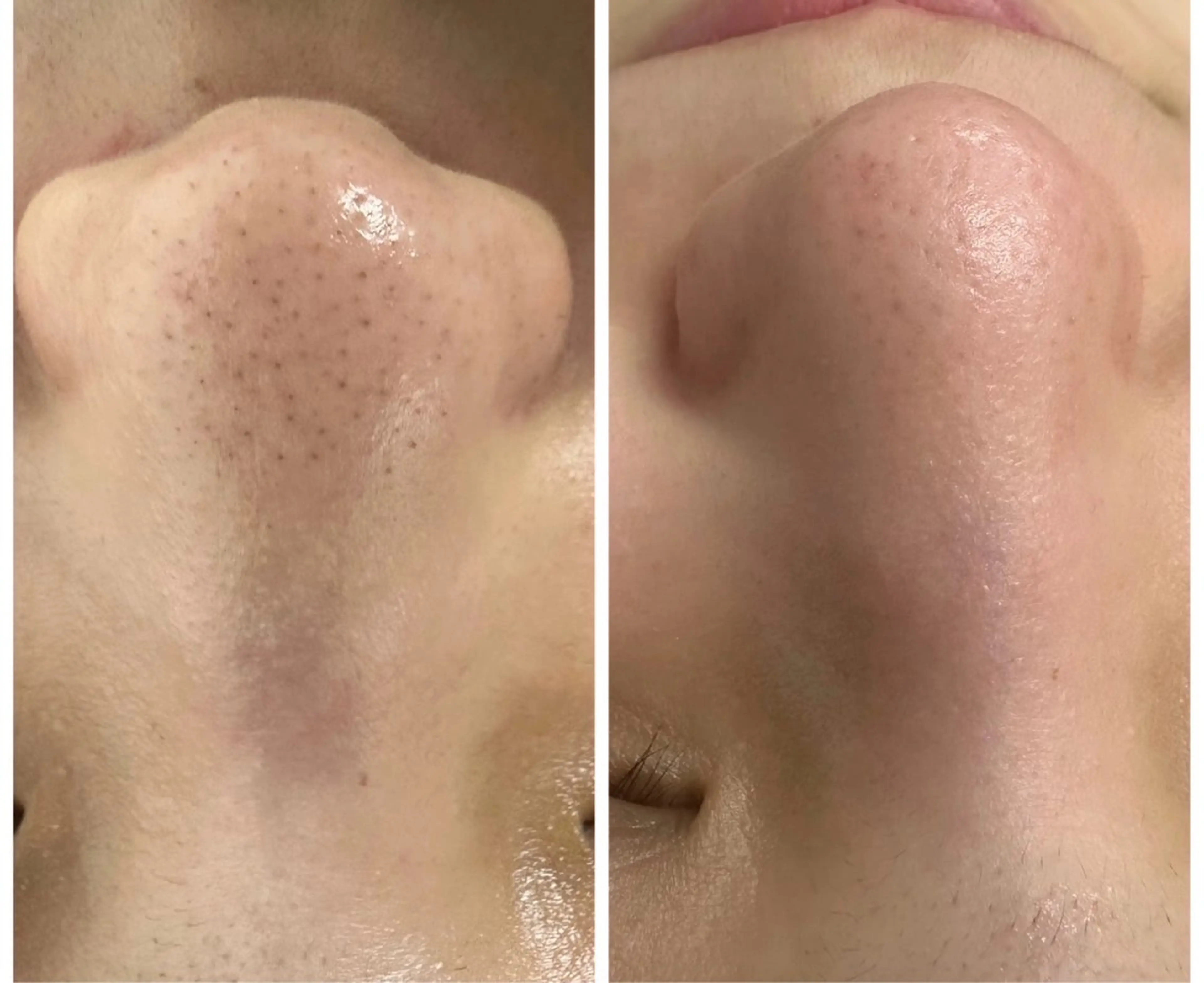 【毛穴洗浄🍓✨】ニキビ/美白パック付き✨の写真