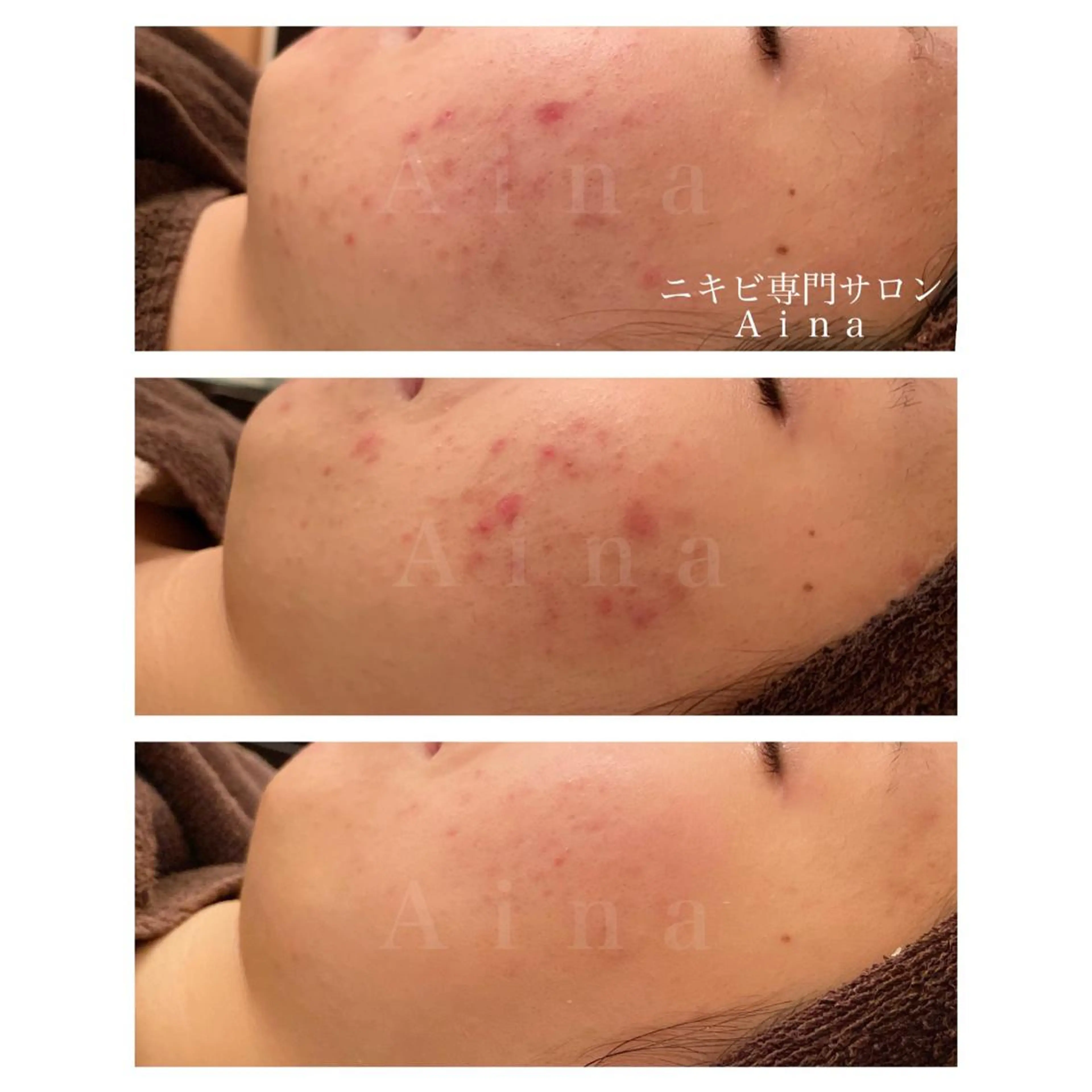 セミロング パーマ ヘアアレンジ メンズ キッズ ネイル マツエク・マツパ アイブロウ 赤色 エステ リラク ニキビ跡専門サロン Ainaのエステ・リラクイメージ