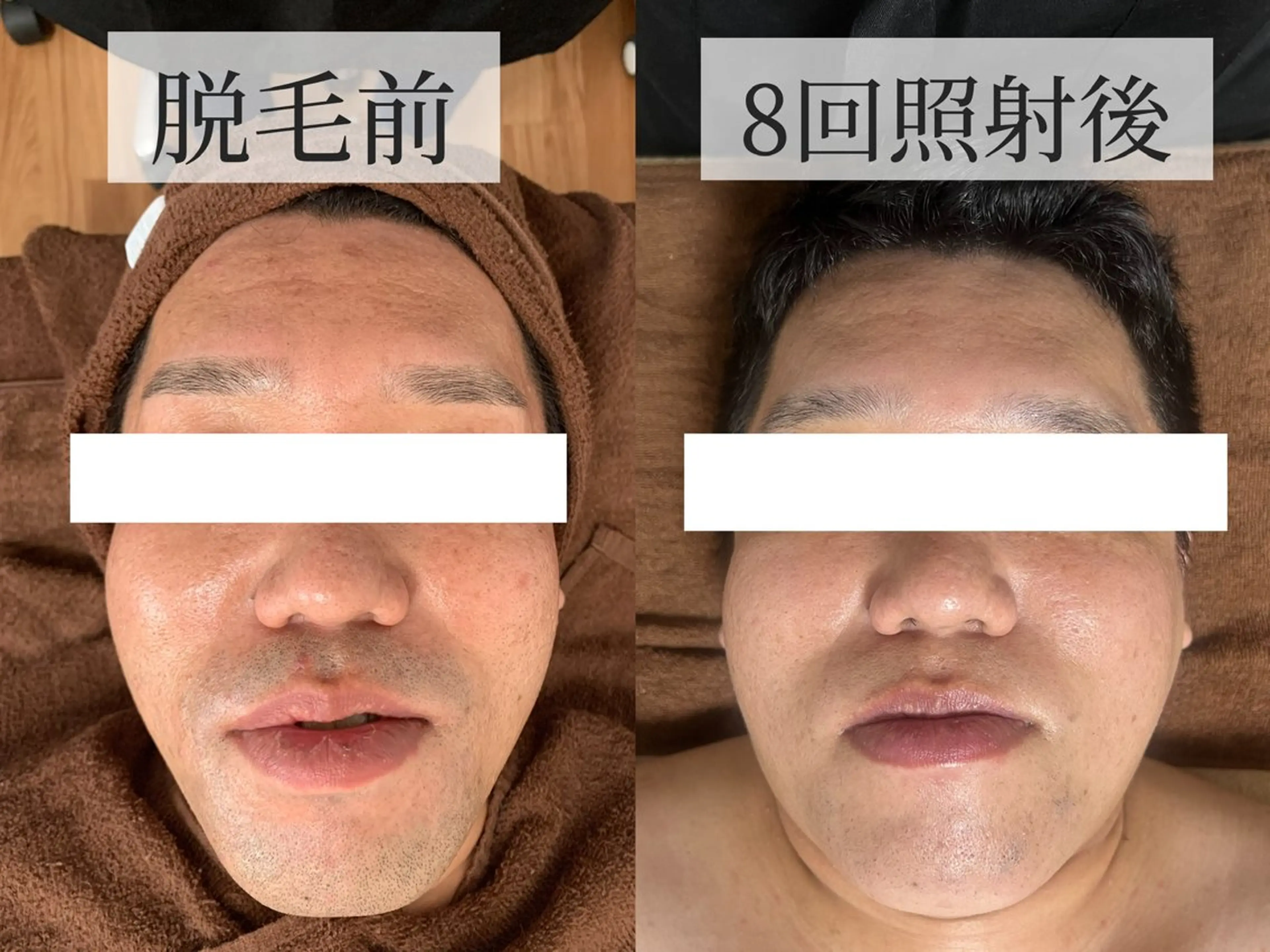 🚹【メンズ全顔脱毛】1回のみの使用可能です☘️お顔のトーンアップ、毛穴開きの改善、肌荒れ防止にも繋がります🌟の写真