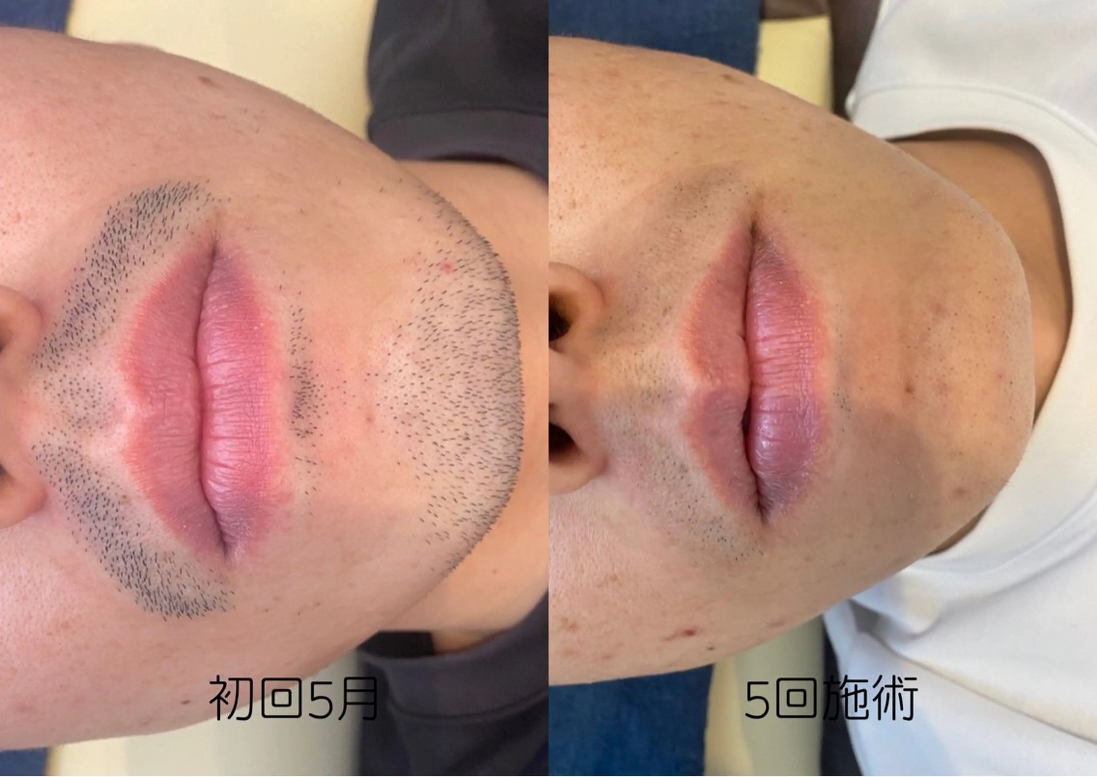 脱毛 シエスタ 山下 上級脱毛士のエステ・リラクイメージ