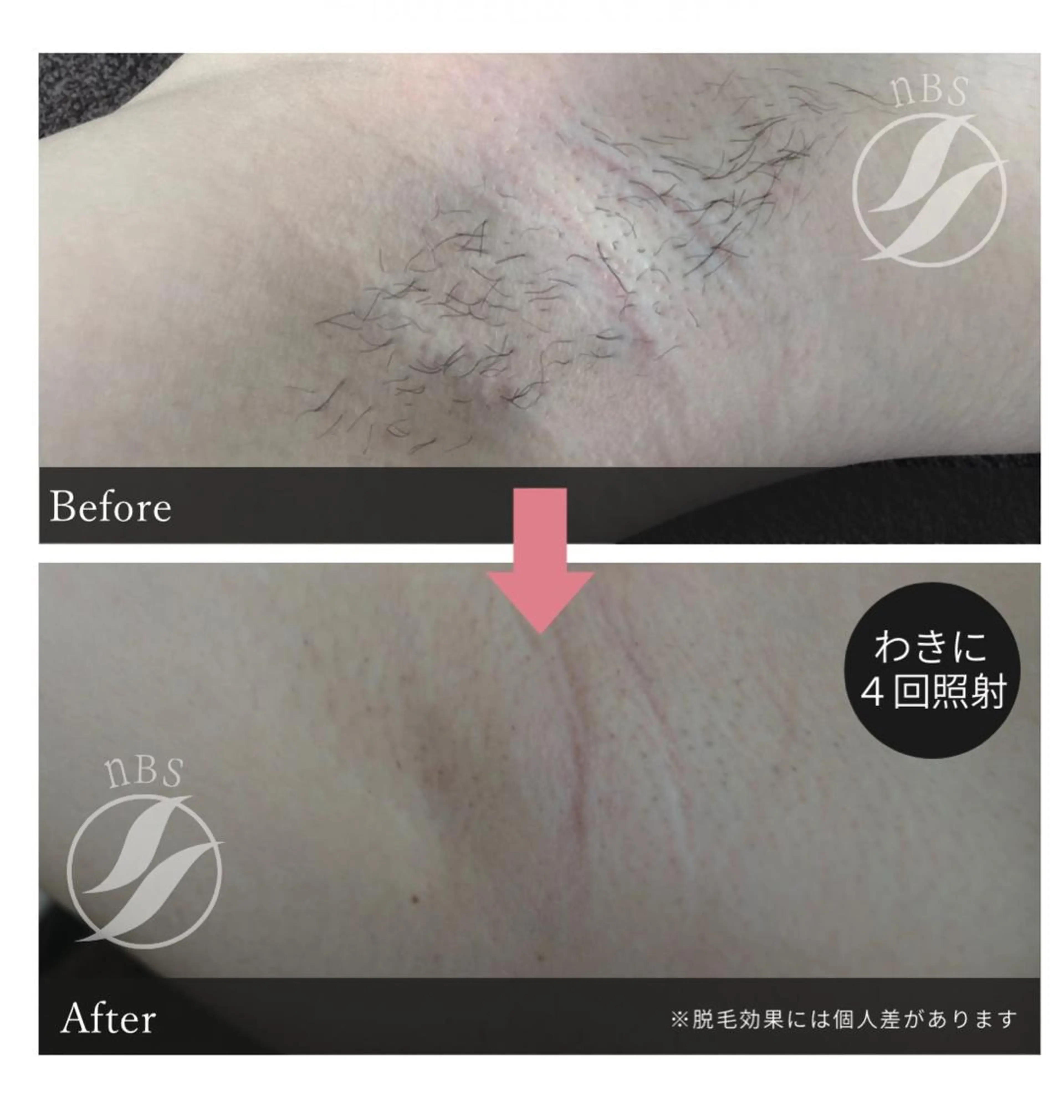 ワキ脱毛✖️3回の写真