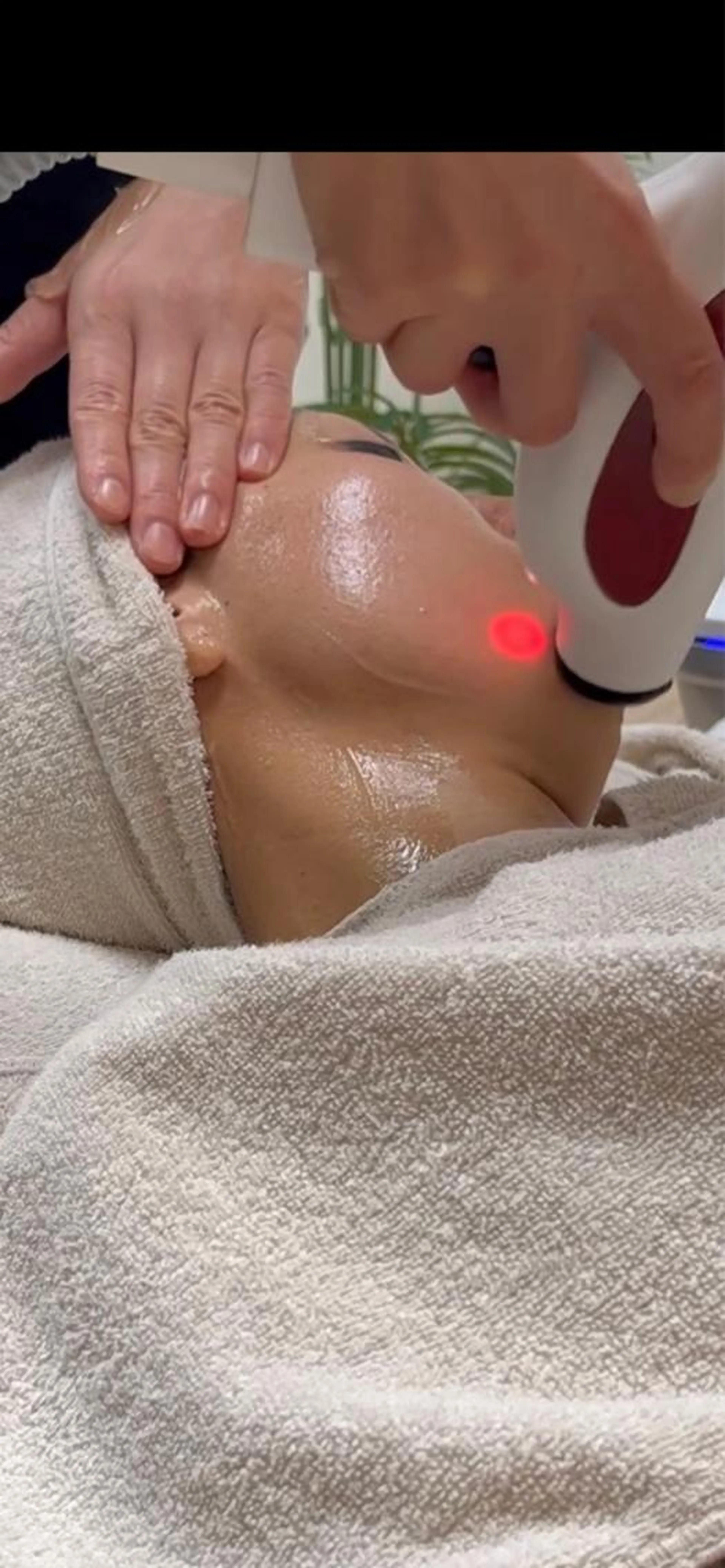 ラジオ波フェイシャルエステ（小顔、たるみ、シワが気になる方に✨）の写真