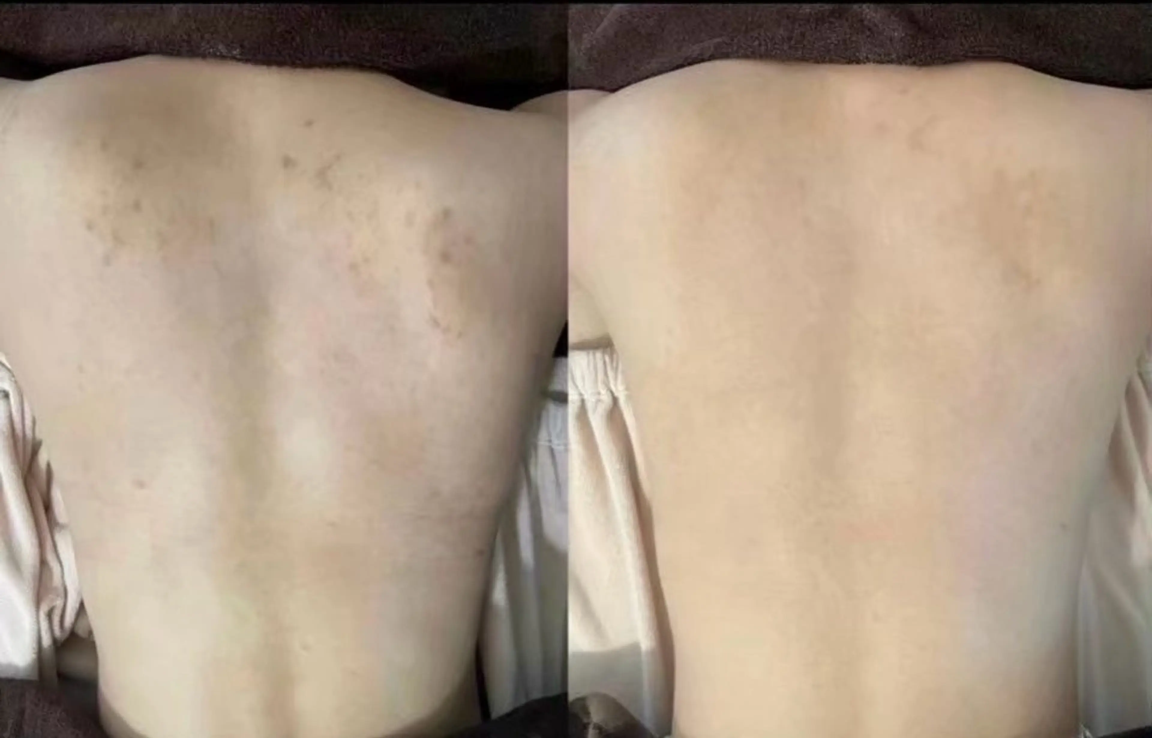 【背中全体】剥離ありハーブピーリング🌿ニキビ・ニキビ跡・毛孔性苔癬・色素沈着の写真