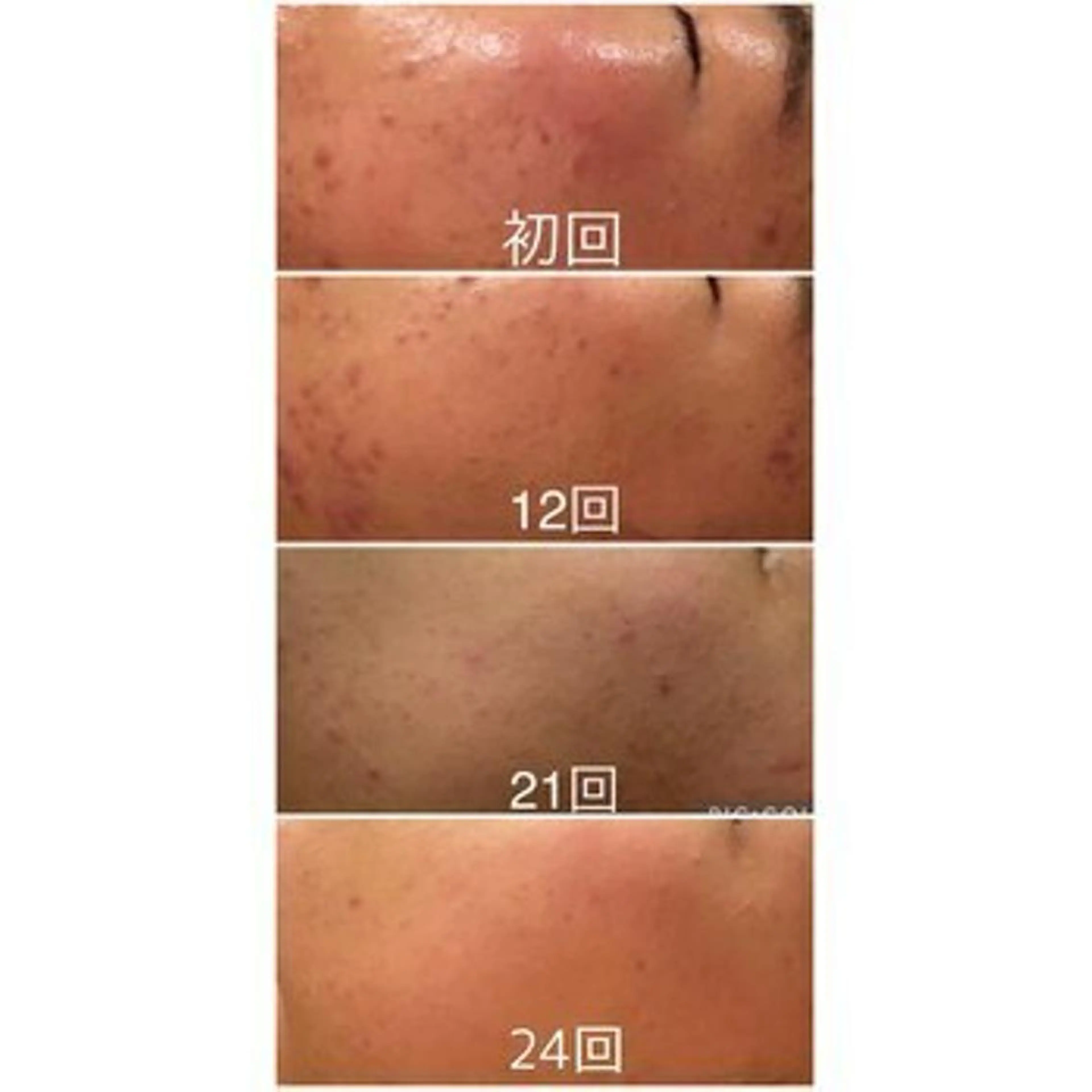 6万人の美肌実績🔥 最短ニキビ改善のエステ・リラクイメージ