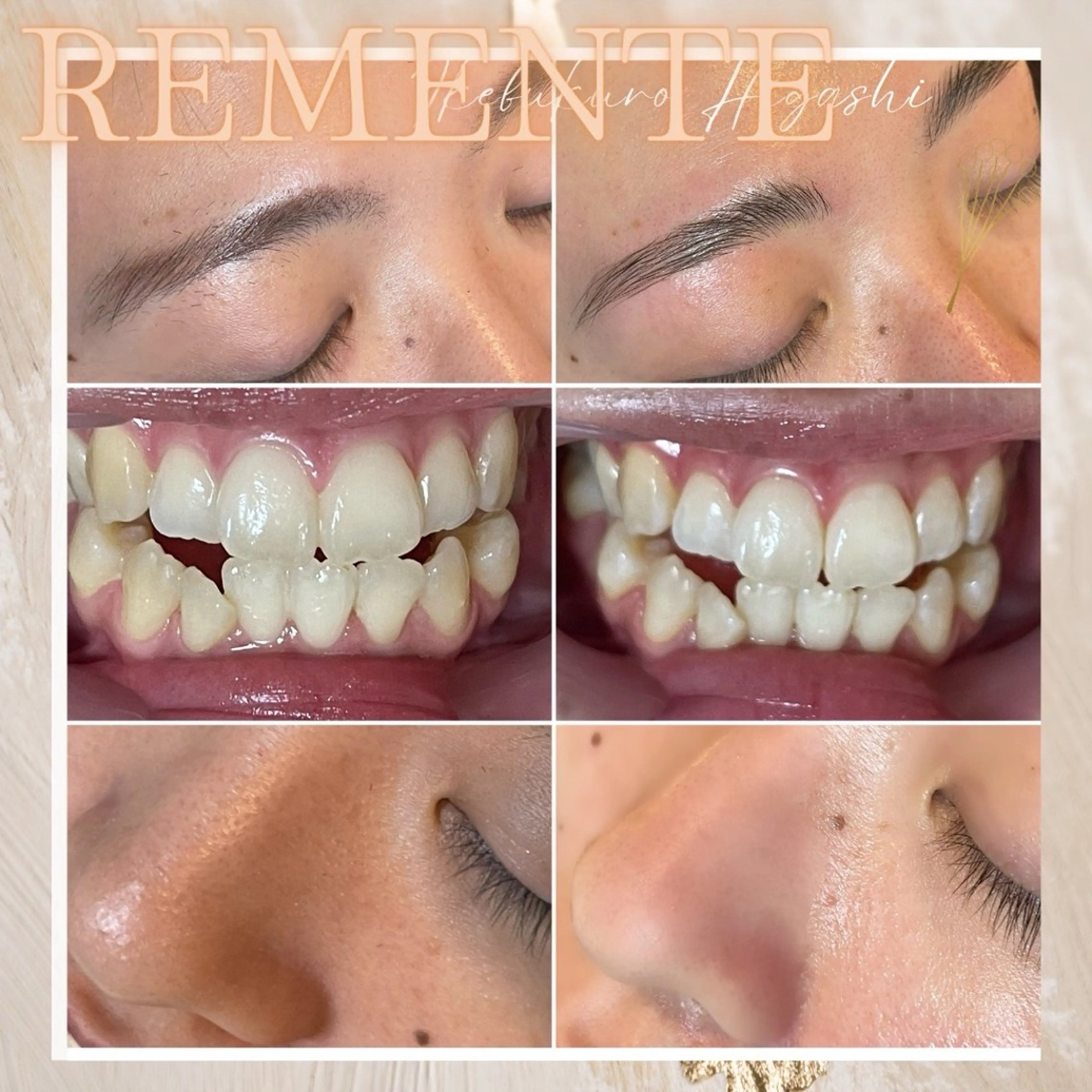 【ハイドラフェイシャル+ホワイトニング+美眉デザイン】今月1名様限定🌹3点同時施術できるのはココだけ✨の写真