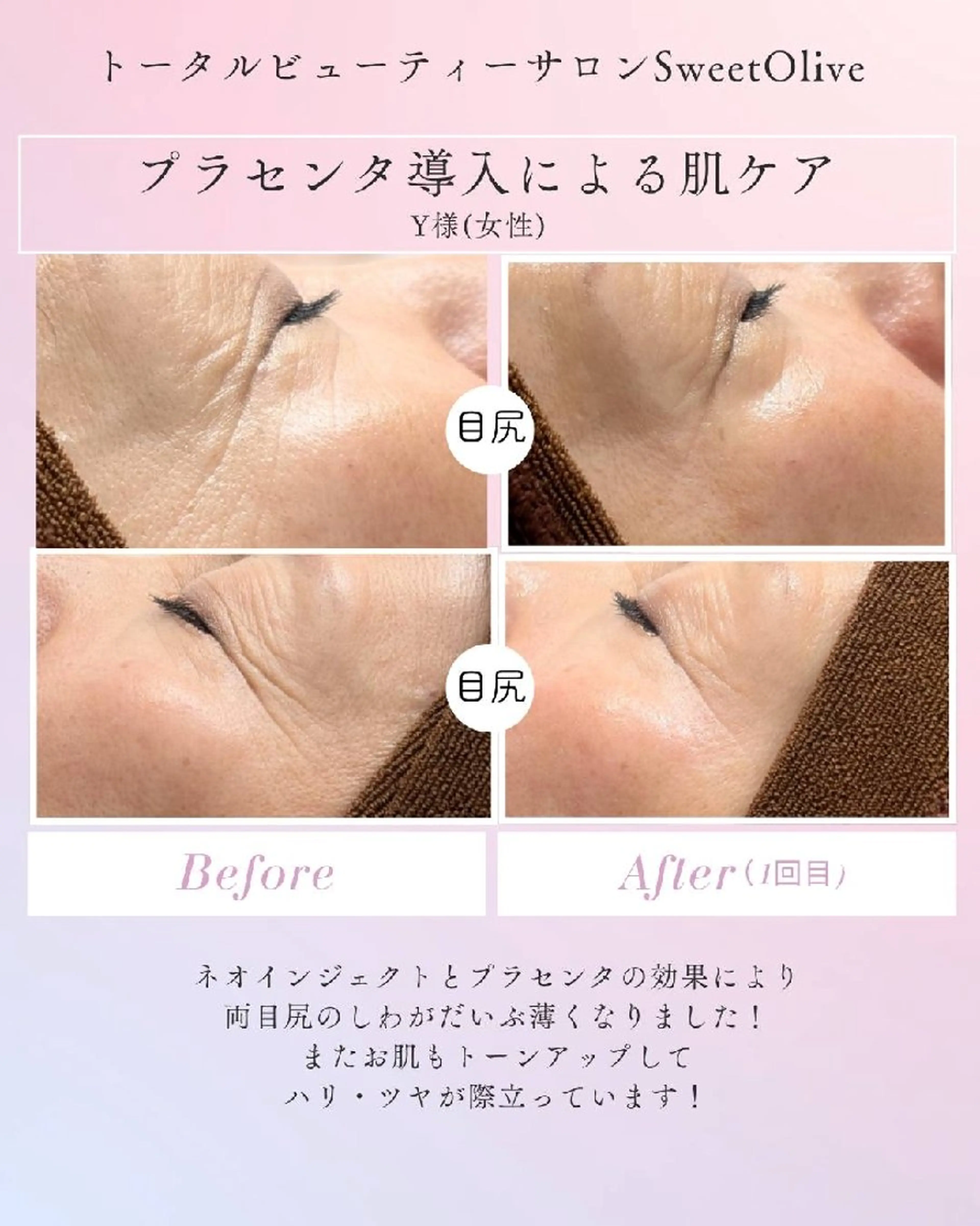 【メンズもOK】プラセンタフェイシャル（高速エアジェット）30分の写真