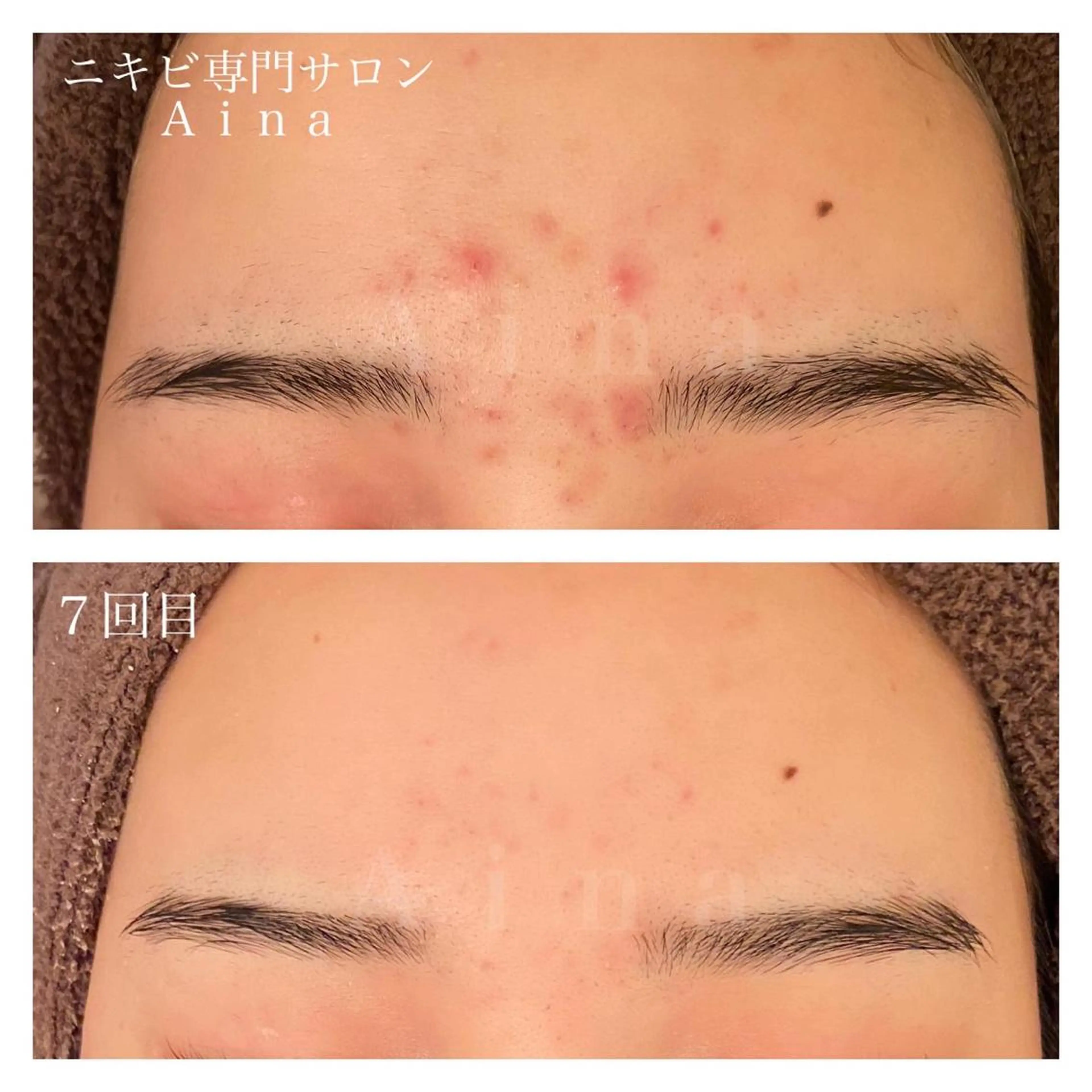 セミロング パーマ ヘアアレンジ メンズ キッズ ネイル マツエク・マツパ 卒業式のヘアスタイル 卒業式 赤色 ニキビ跡専門サロン Ａｉｎａのエステ・リラクイメージ