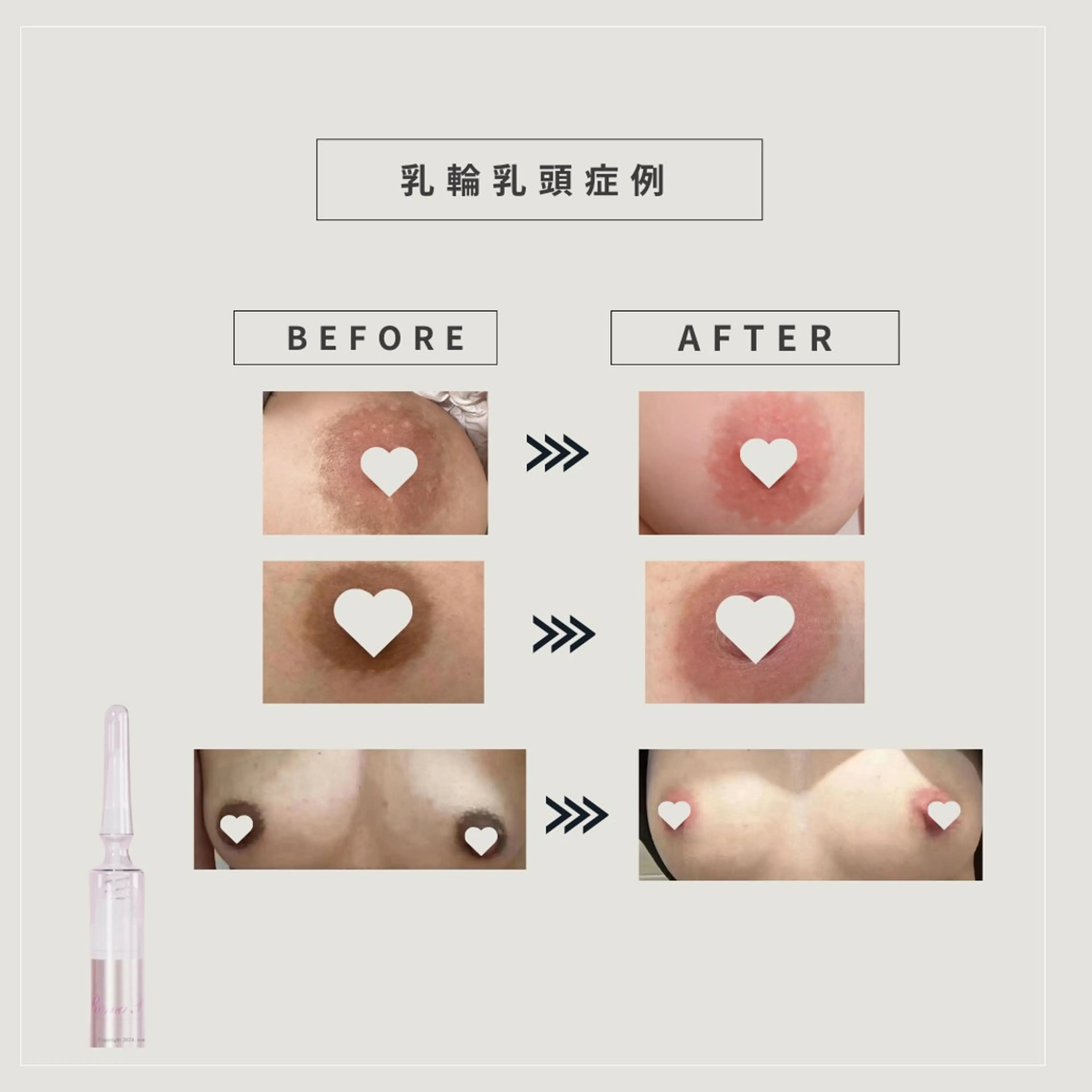 60%OFF(特典含む)【ローマピンク🩷ニップル】アフタークリーム3本(39,600円)＋ヒアルロン酸導入プレゼントの写真