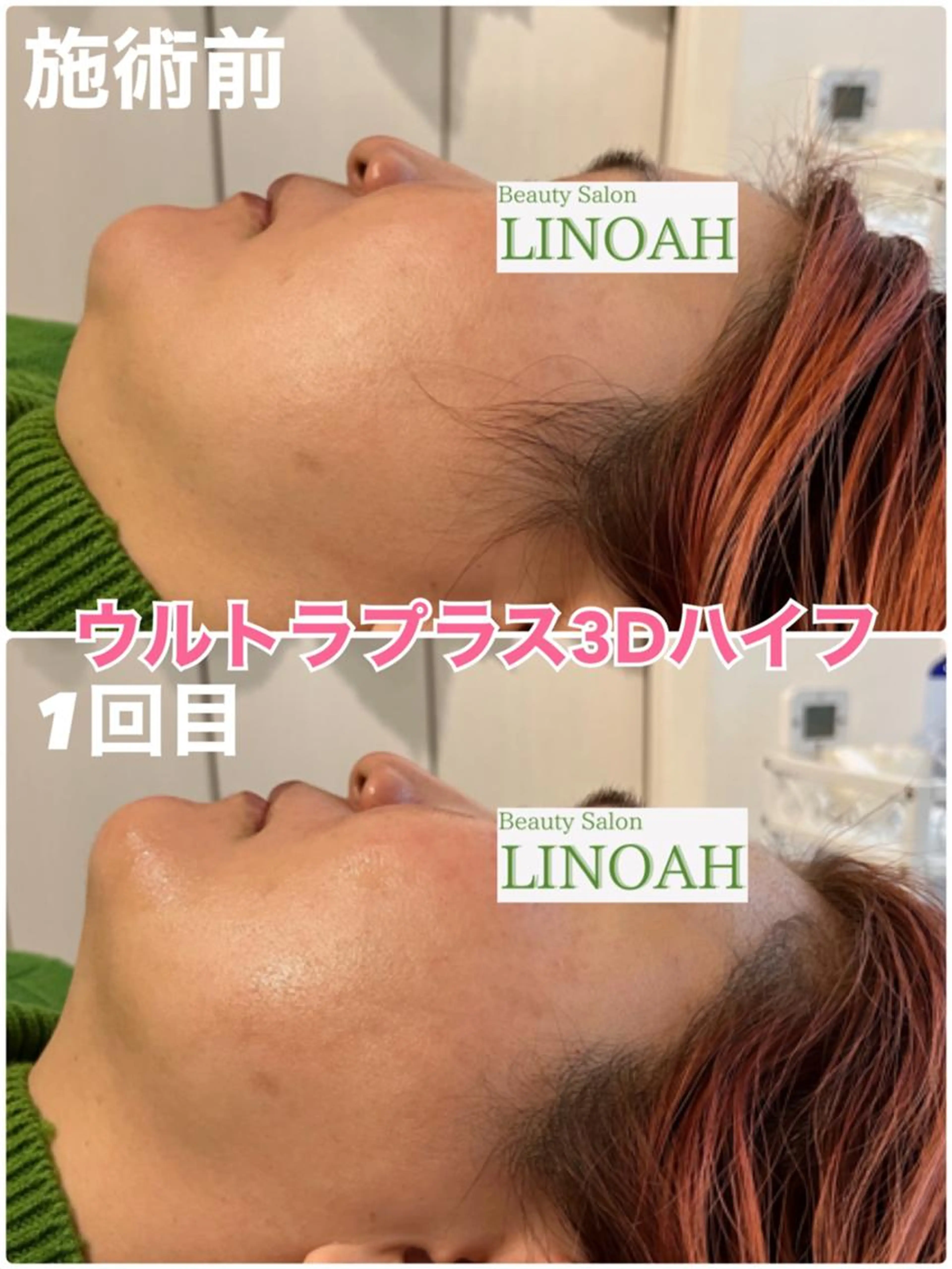 【リンパ/小顔】⭐️ウルトラプラス３Dリフトアップ＋首リンパ付き⭐️￥24800⇒￥14800の写真