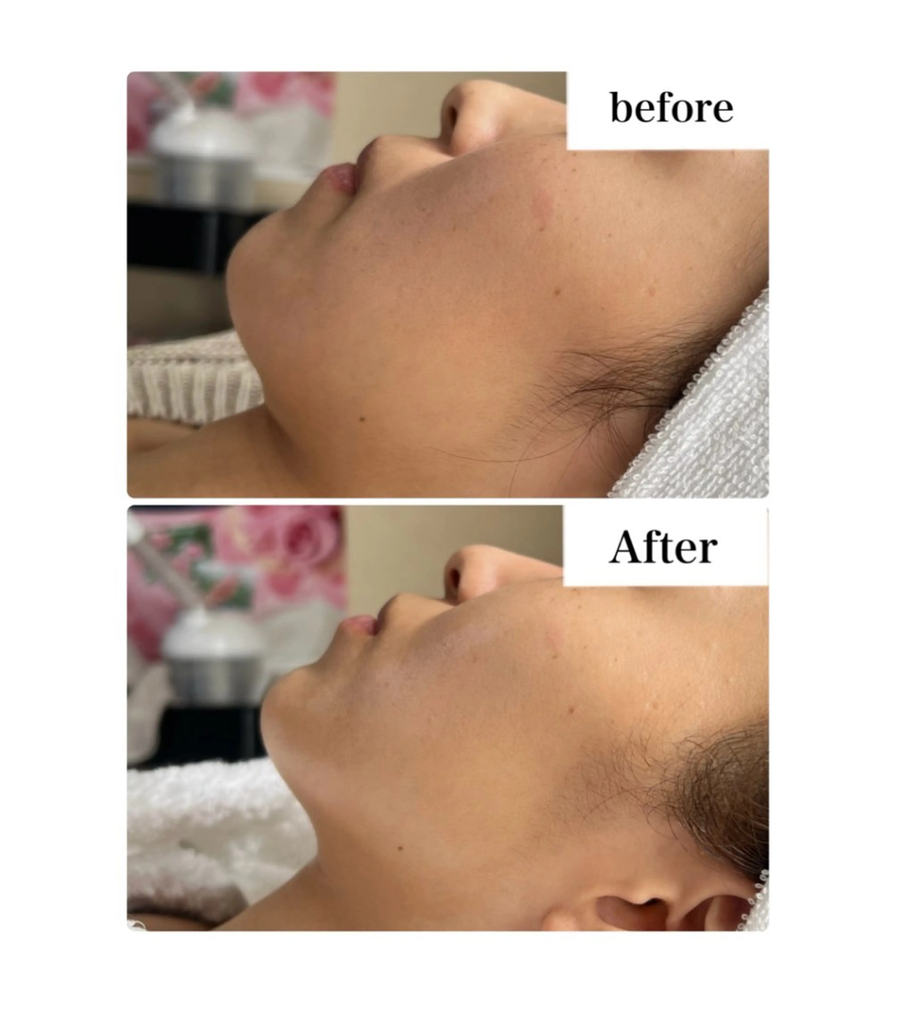 《超音波ソニック》毛穴引き締め×ハリ艶フェイシャル✨️の写真