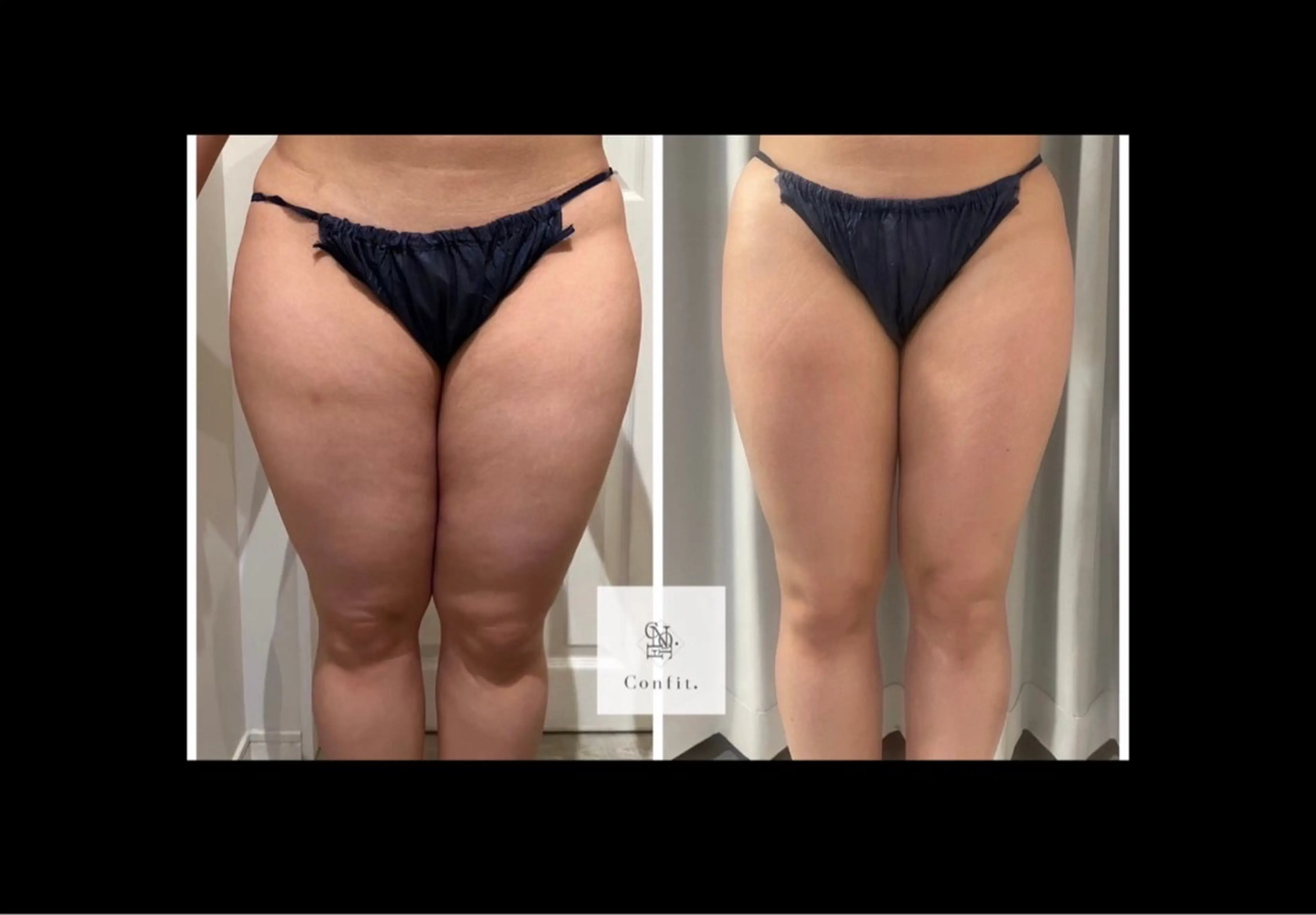 痛みゼロ👌脂肪排泄（お腹.足.背中）の写真