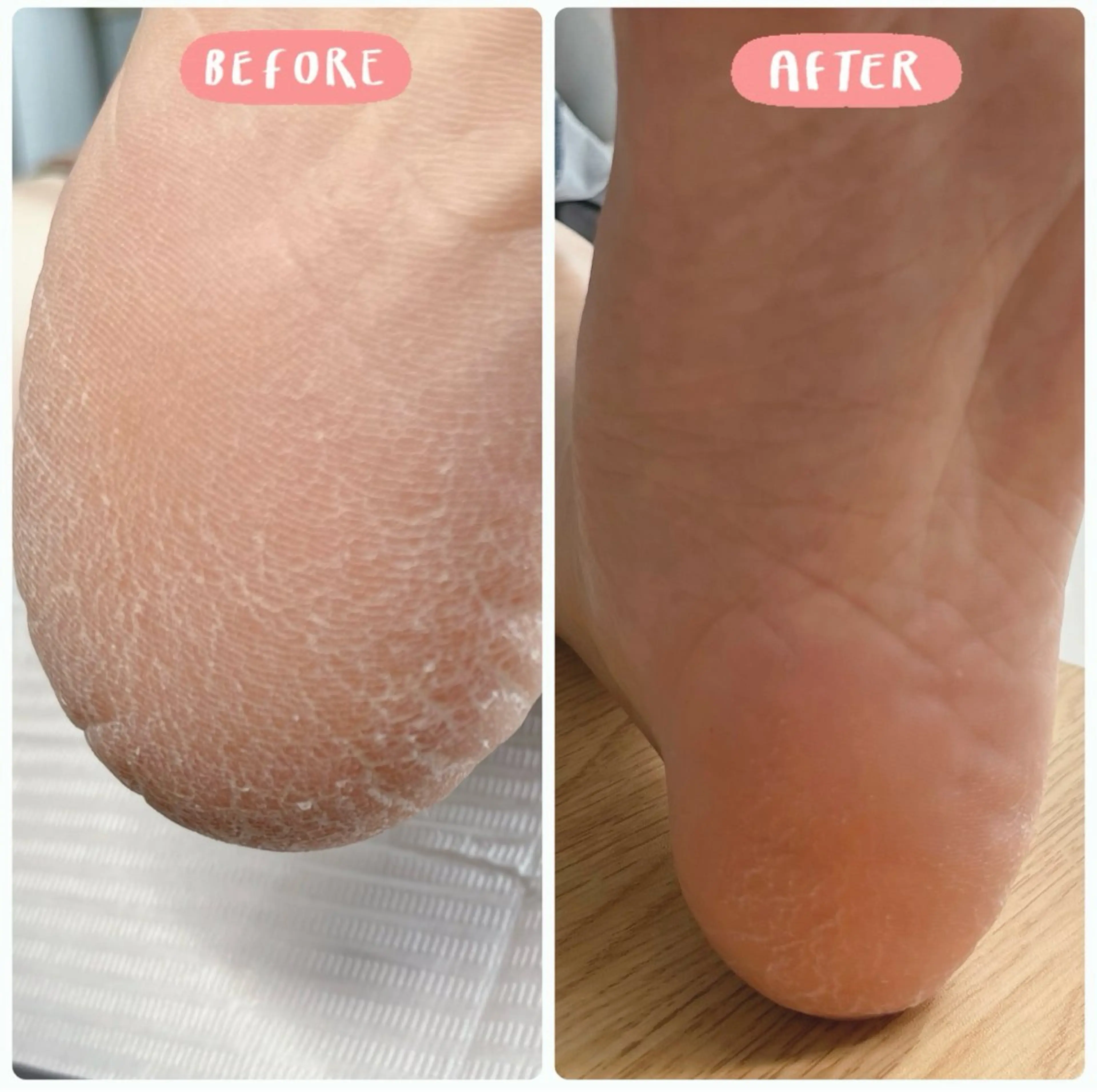 🦶つるつる角質🌟フットケアモニター募集🦶の写真