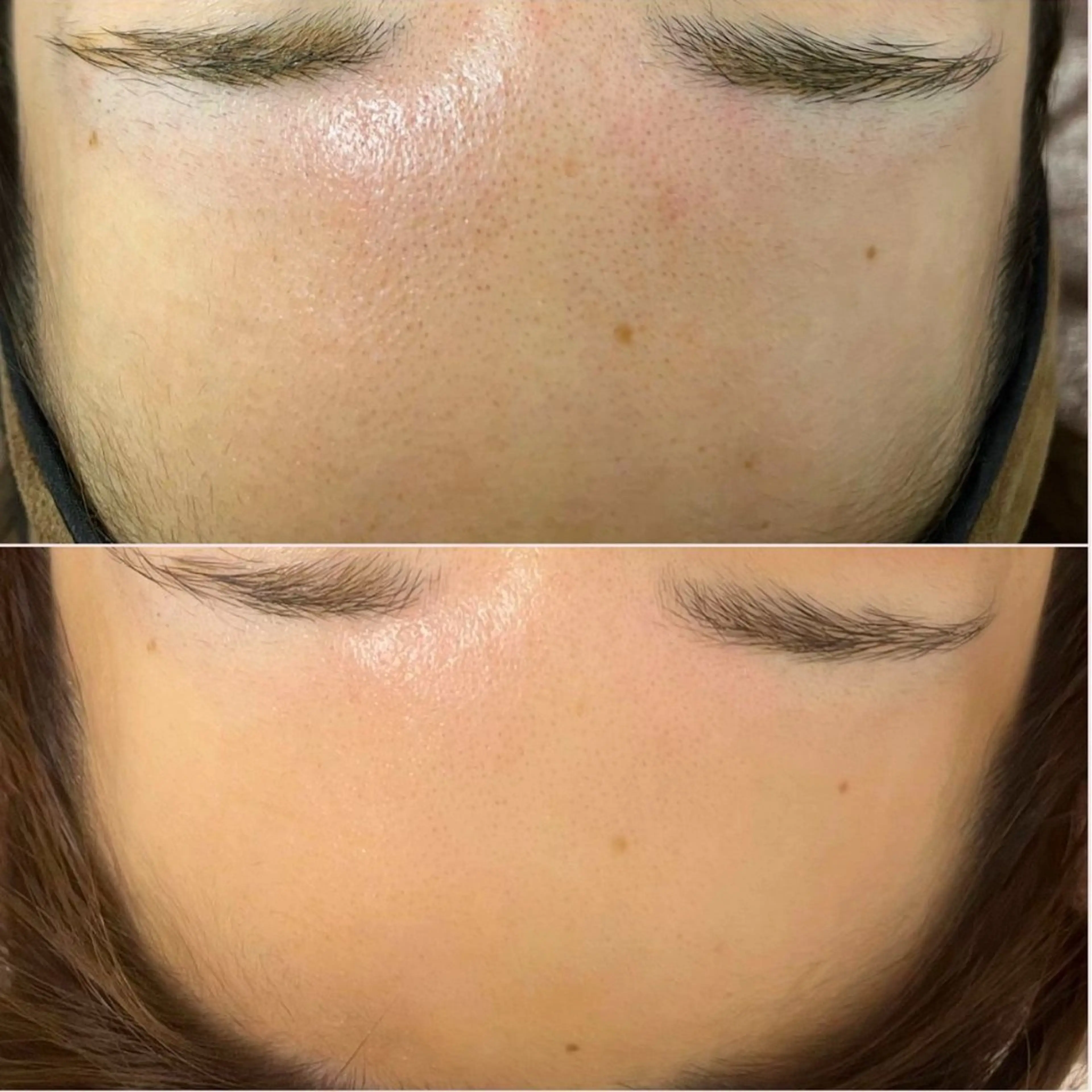 痛くないリジュラン2.5cc✨の写真