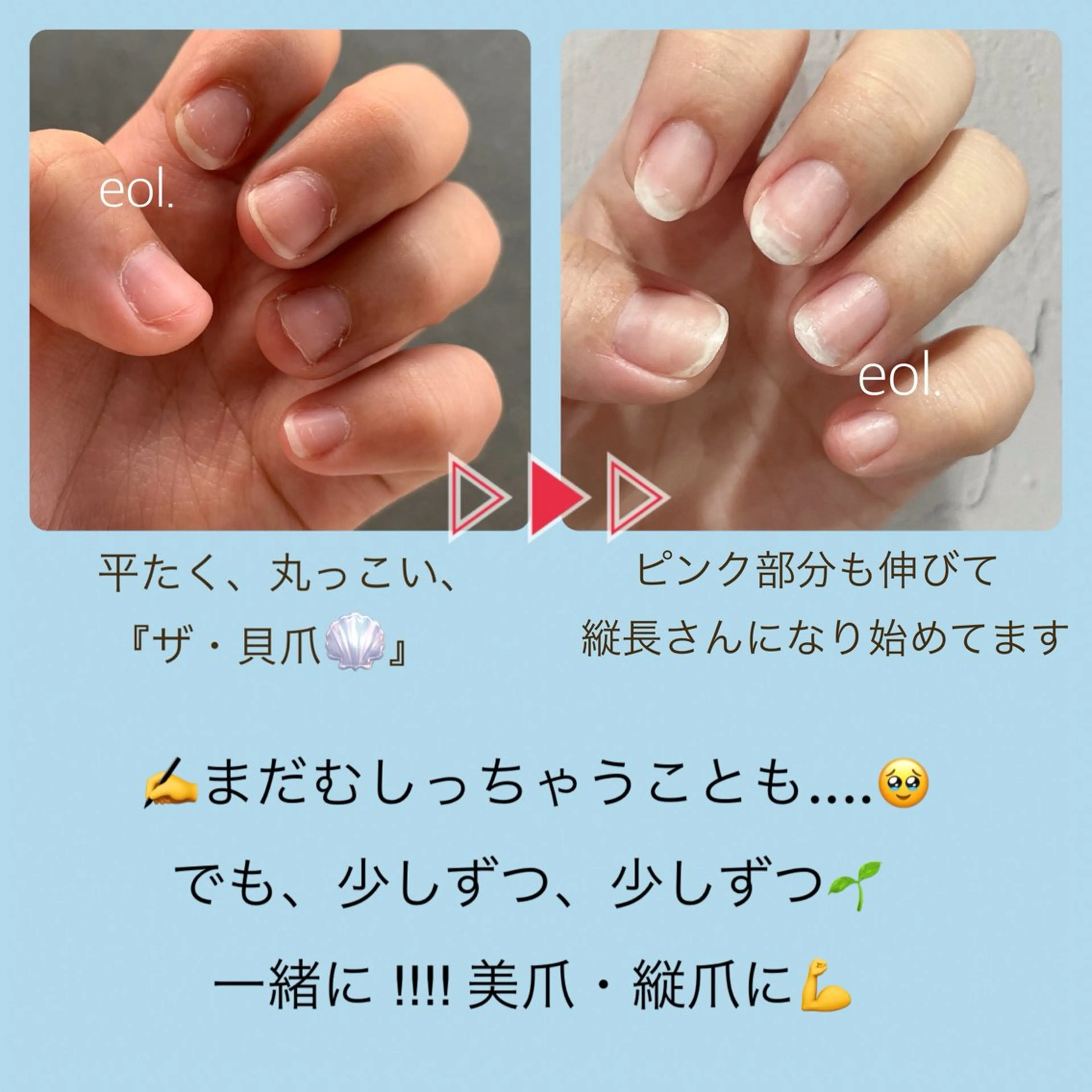 深爪緩和・育成🌱『艶ありクリアor自爪風マット仕上げ』【ホームケアオイル付き⭐️】の写真