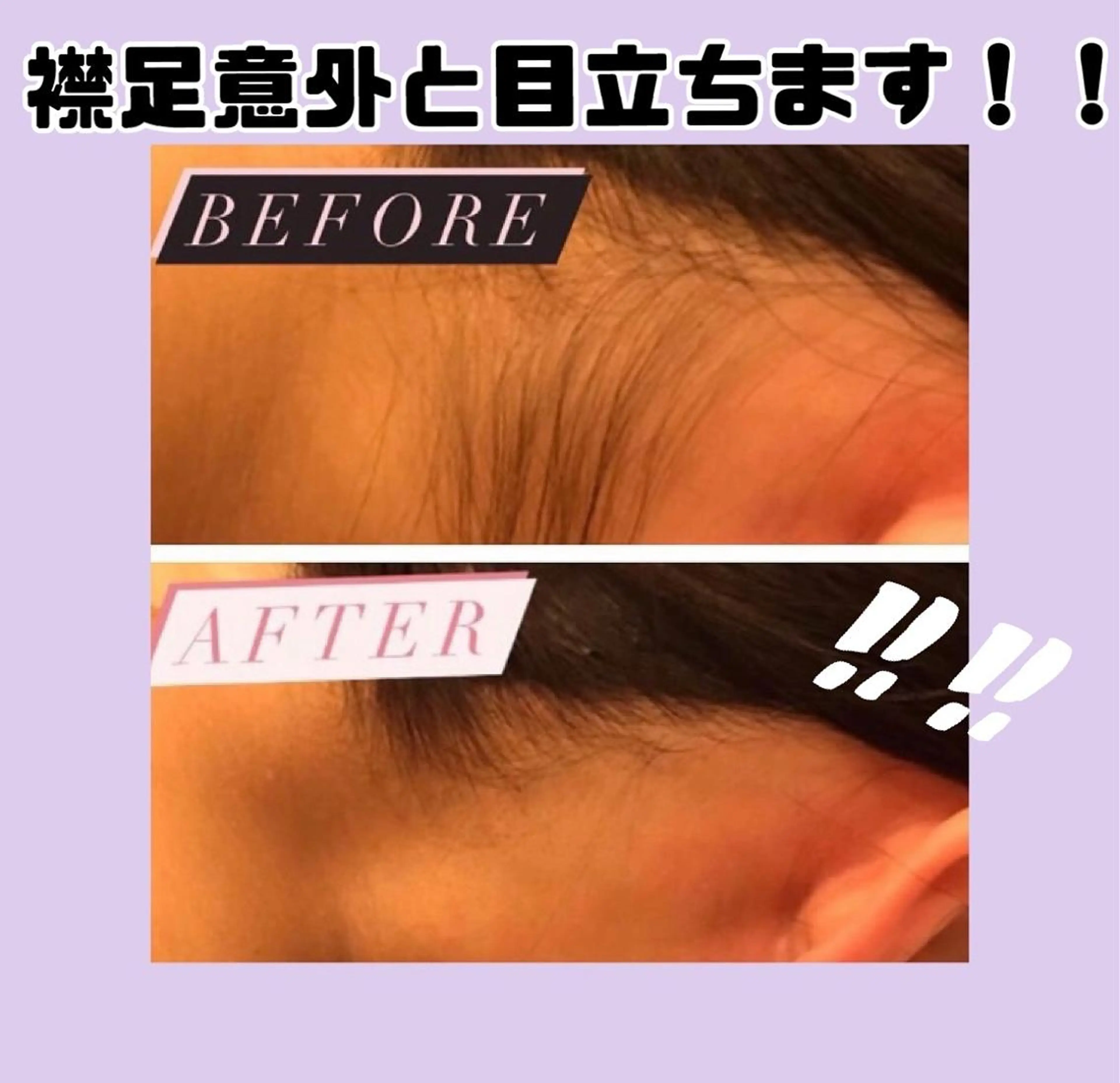 【気になる箇所★】えりあし脱毛体験の写真