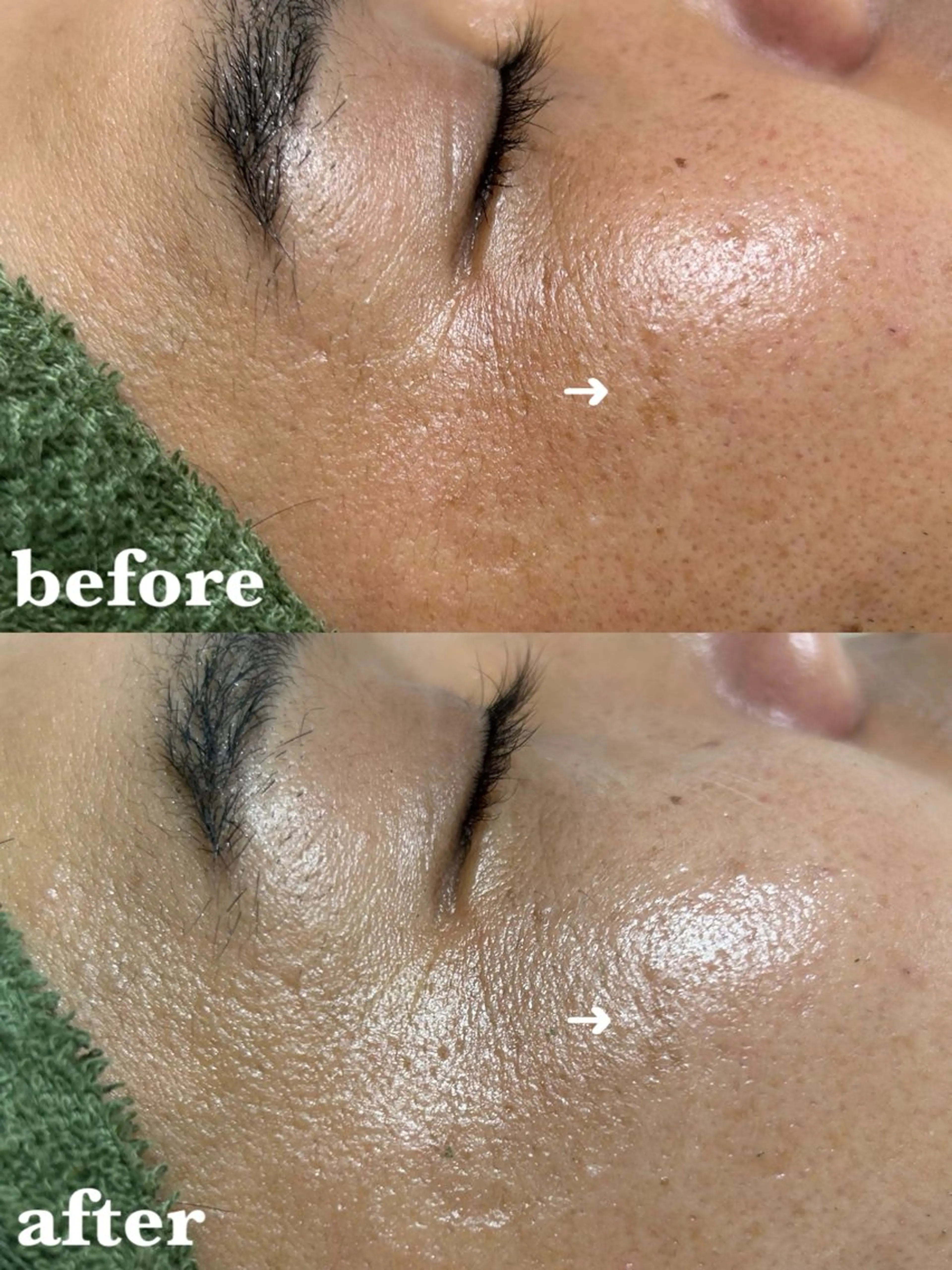 【シミ･そばかす】陶肌トリートメント¥11,000(陶肌パウダー1ｇプレゼント価格)の写真