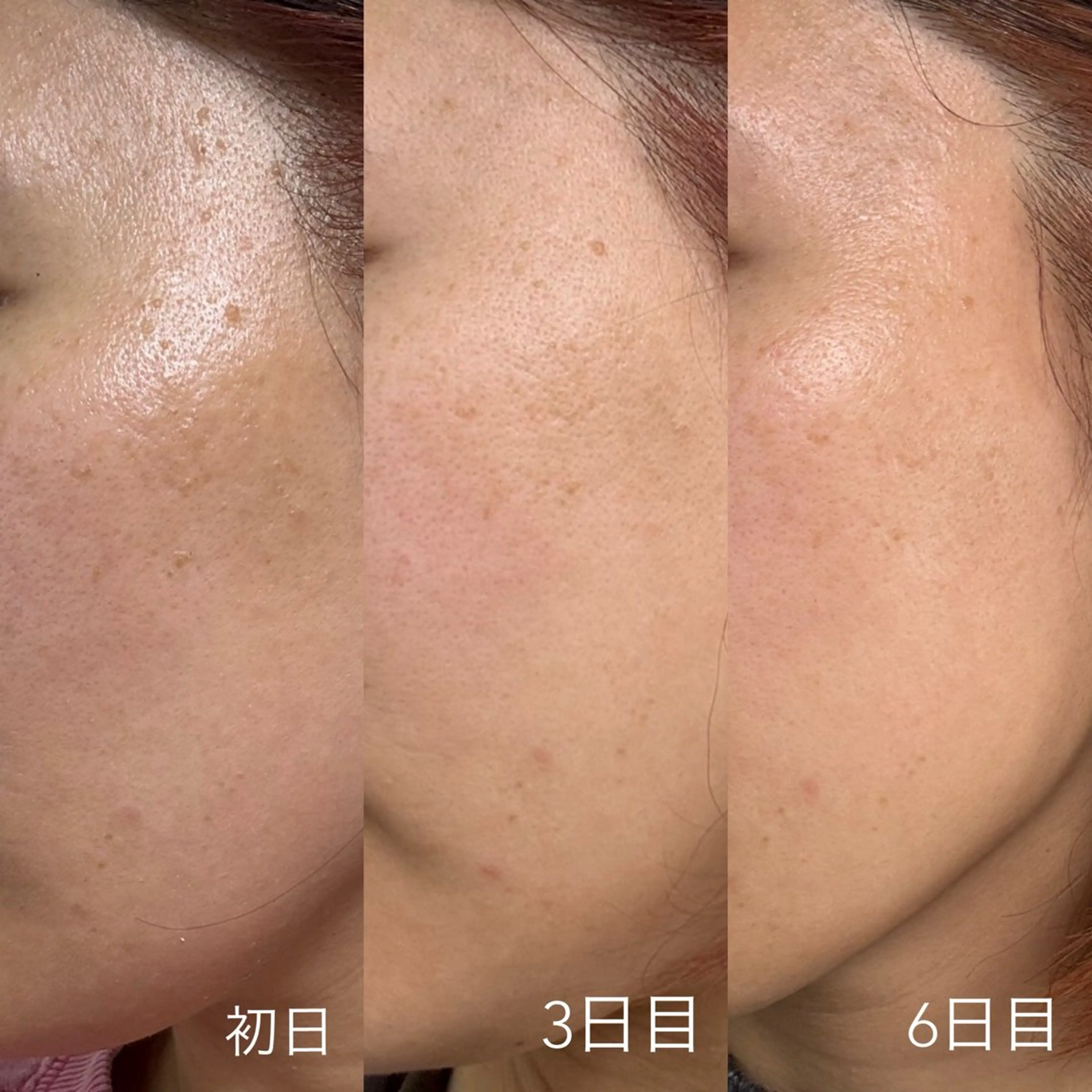 モニター募集⭐︎本気で肌質改善したい方 ダウンタイムありハーブピーリング revi ハーブピーリング 剥離ありの写真