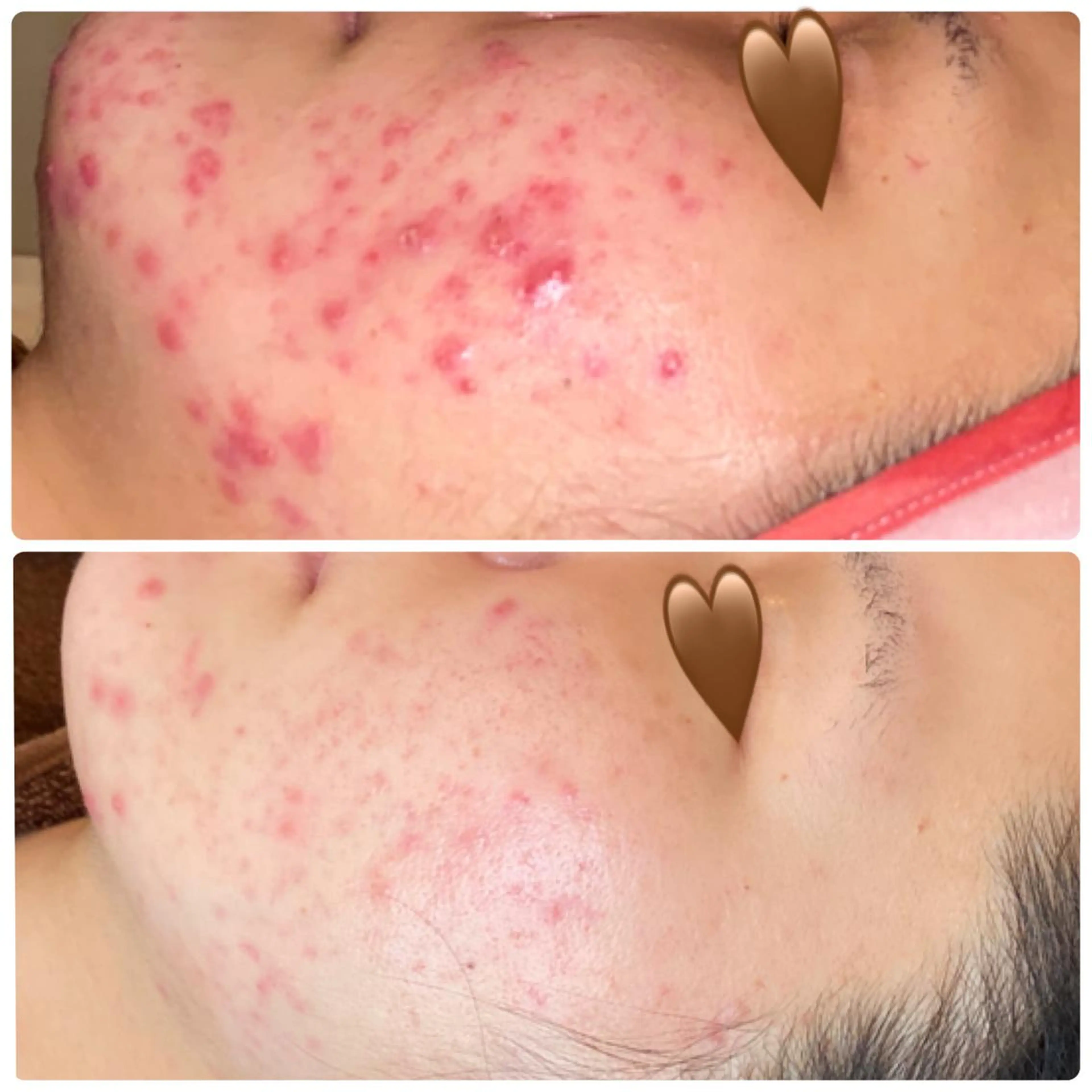 ミニモ限定🌱医療提携サロン【🌿ハーブピーリング】最強の肌質を‼️選べる半顔のハーブの写真