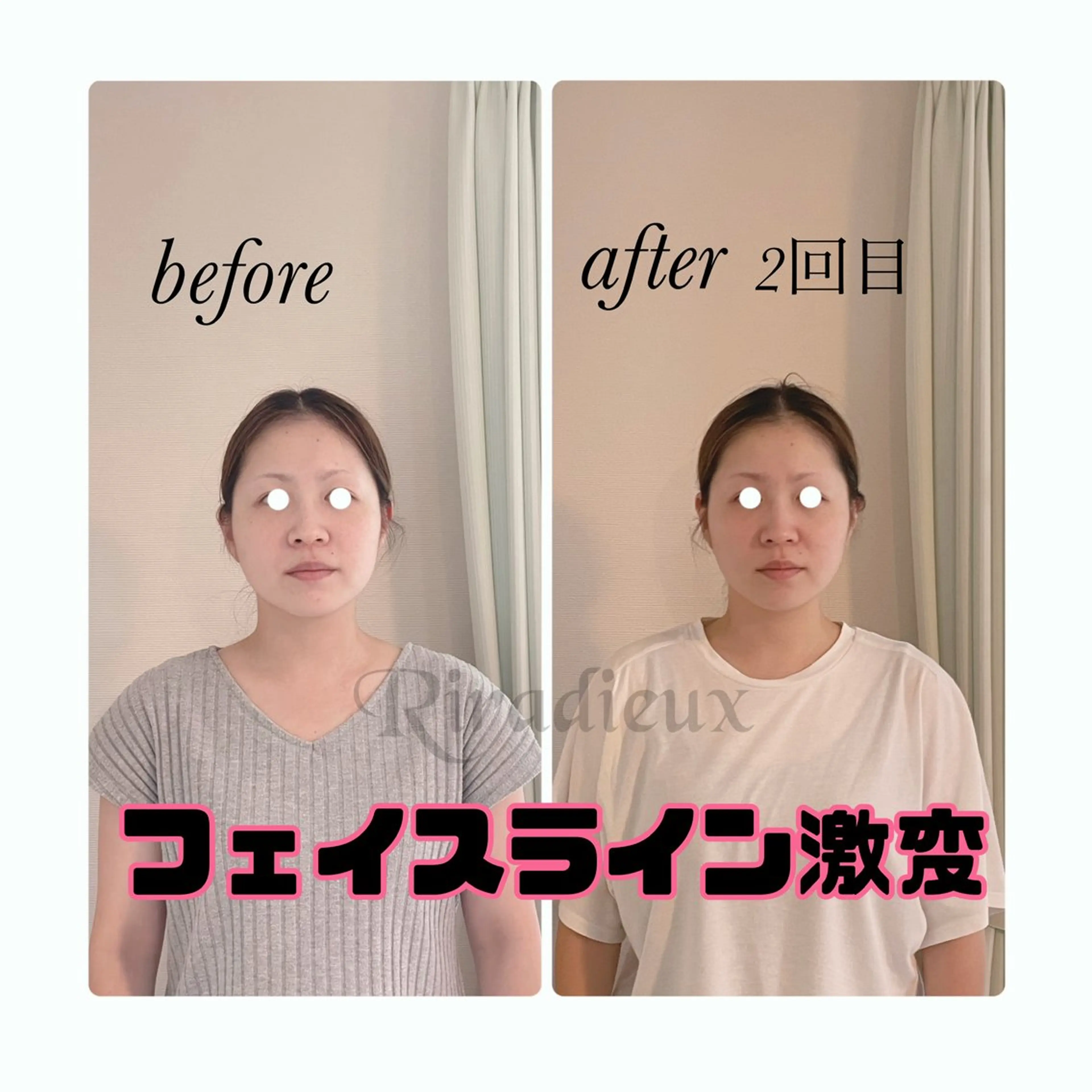 Riradieux ﾘﾗﾃﾞｭ所属・Riradieux 美骨小顔矯正のその他イメージ