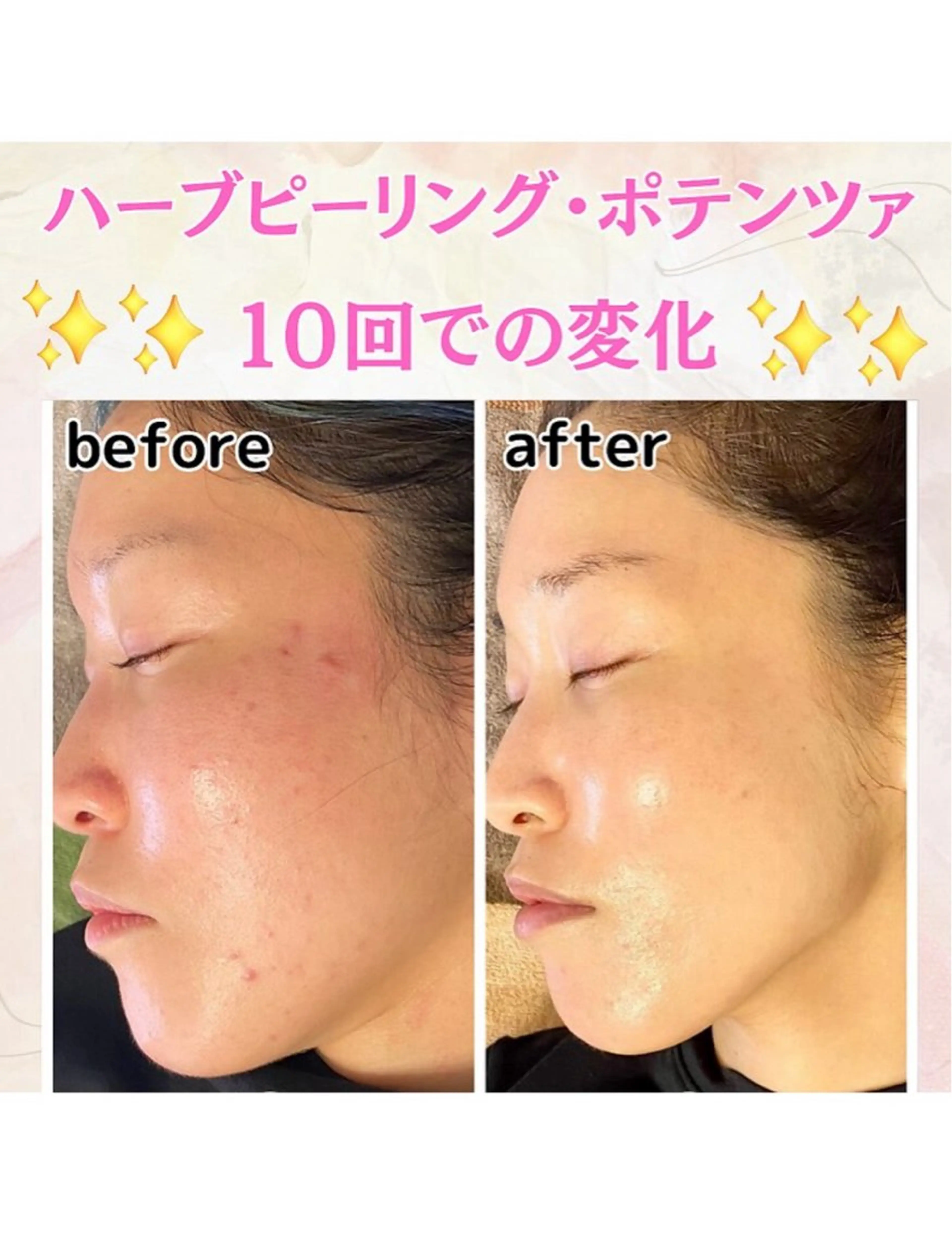 【韓国肌管理】ハーブピーリング　A.DIOR   GINZA所属・松尾 実歩のエステ・リラクイメージ