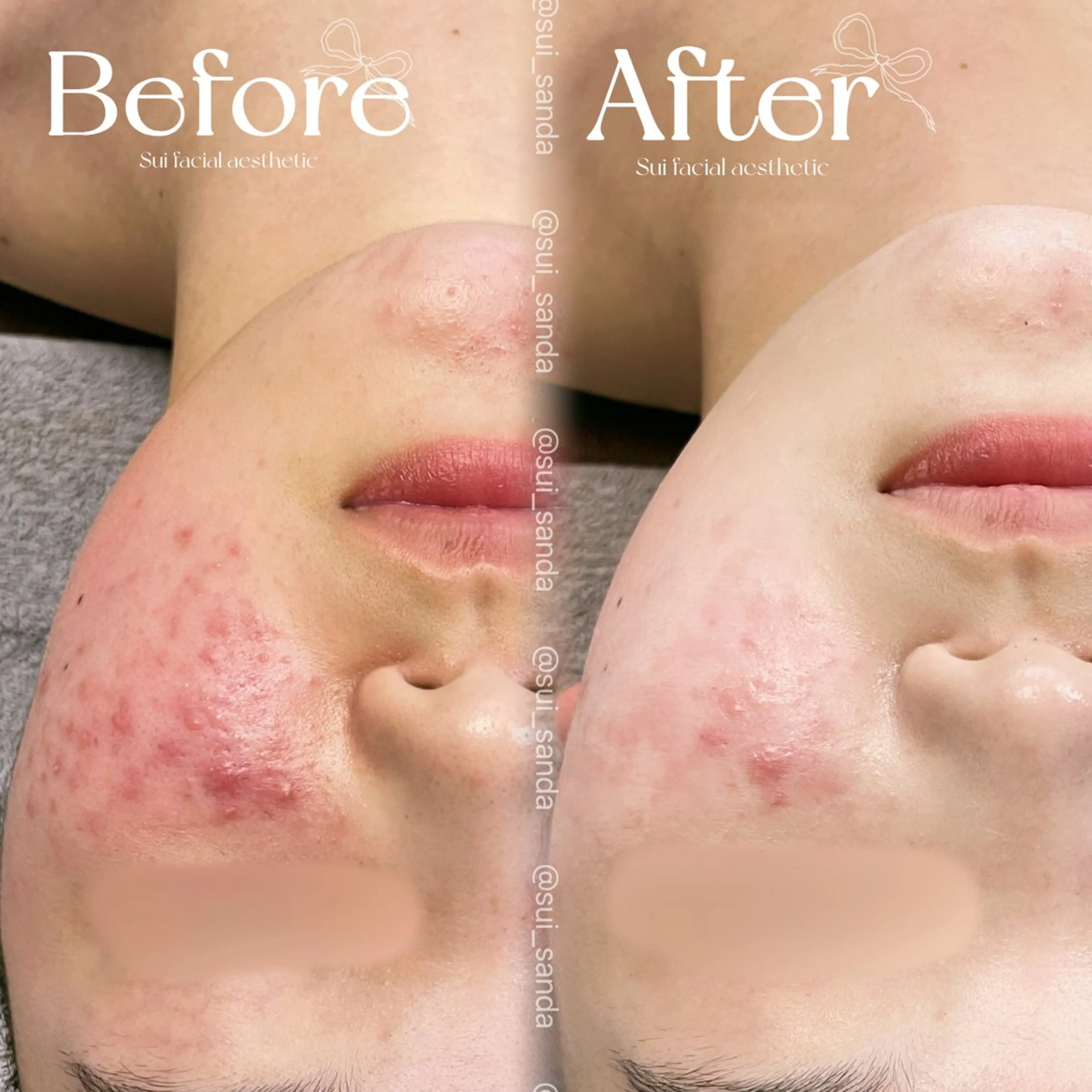 エステ人気No,1🥇【肌革命💎】ニキビ・赤み徹底ケアプランの写真