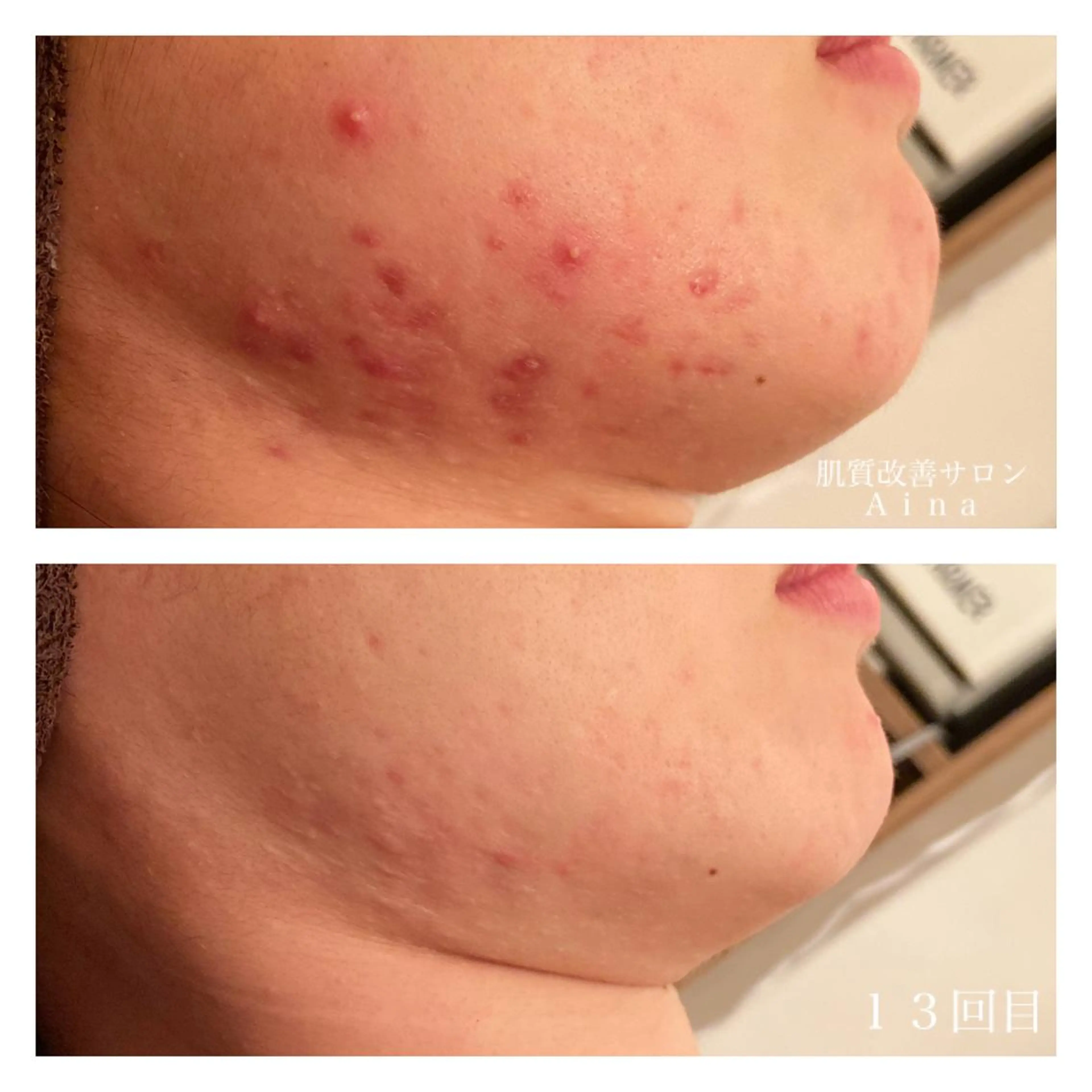 ミディアム カラー パーマ ヘアアレンジ メンズ キッズ ネイル マツエク・マツパ 卒業式のヘアスタイル 卒業式 ニキビ跡専門サロン Ainaのエステ・リラクイメージ