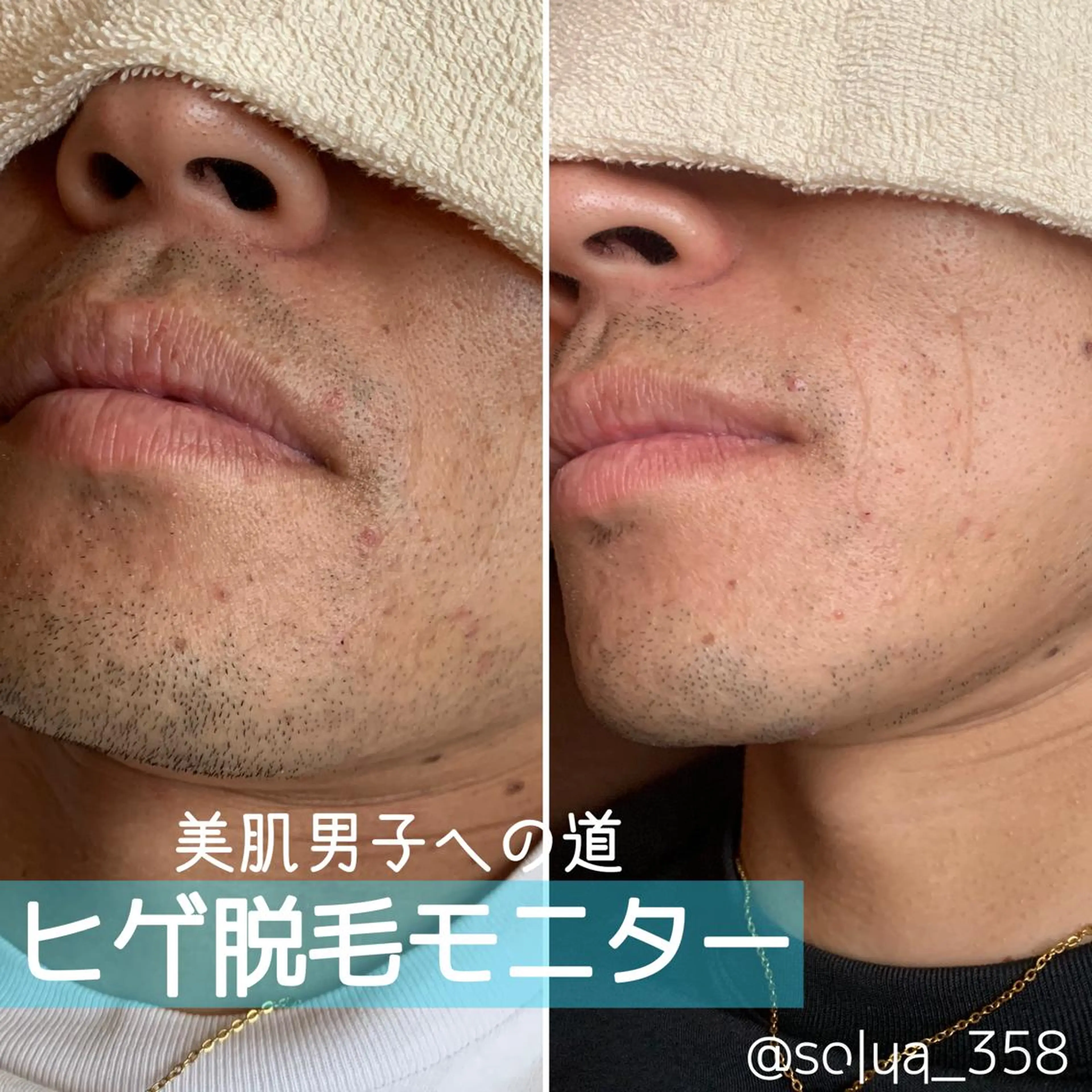 メンズ 脱毛 solua Ayamiのエステ・リラクイメージ