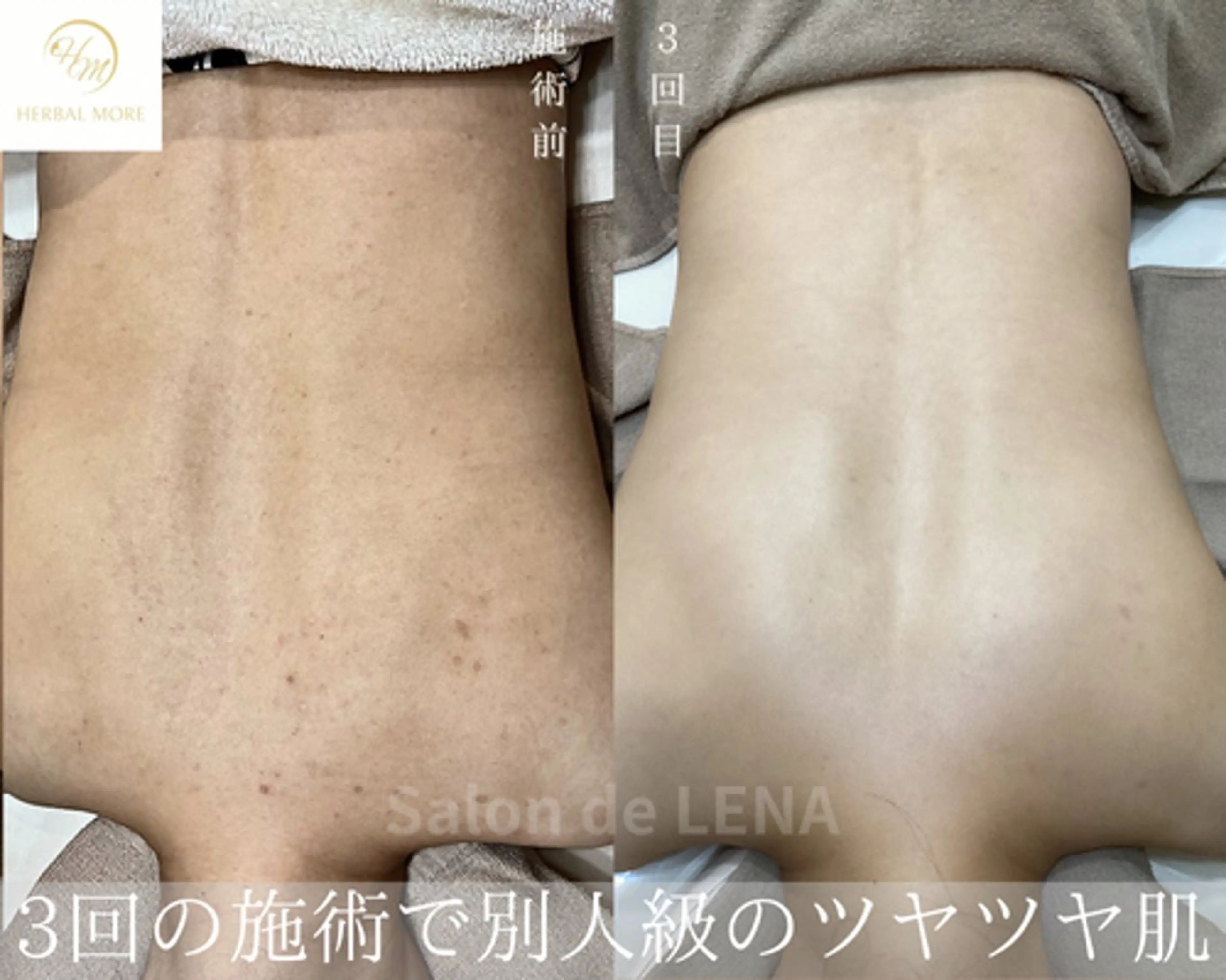 【背中ハーブピーリング/剥離有・無】ニキビケア、色素〇着、毛穴、サメ肌の写真