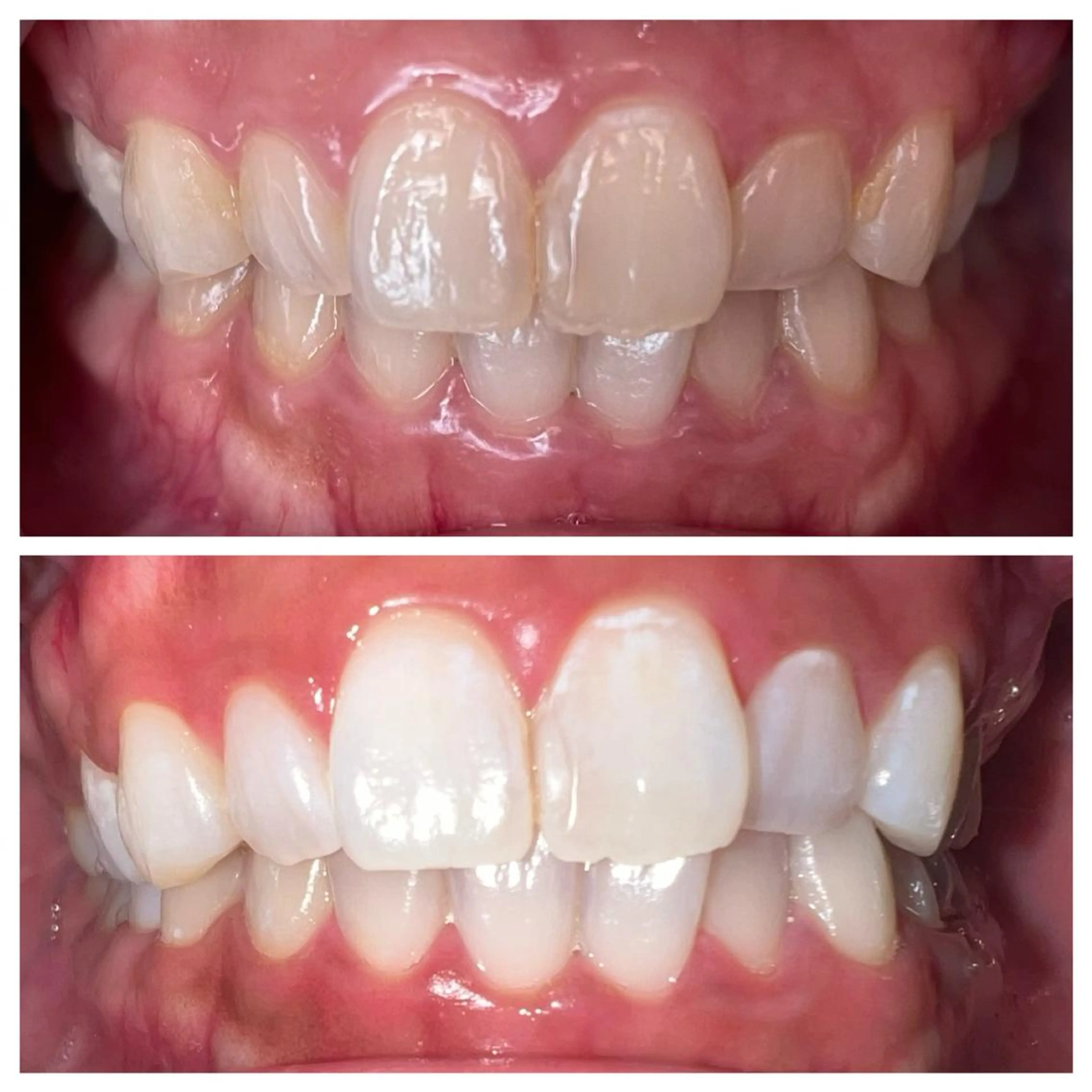 【短期間で白くしたい方♪】セルフホワイトニング15分✖︎3回セットの写真